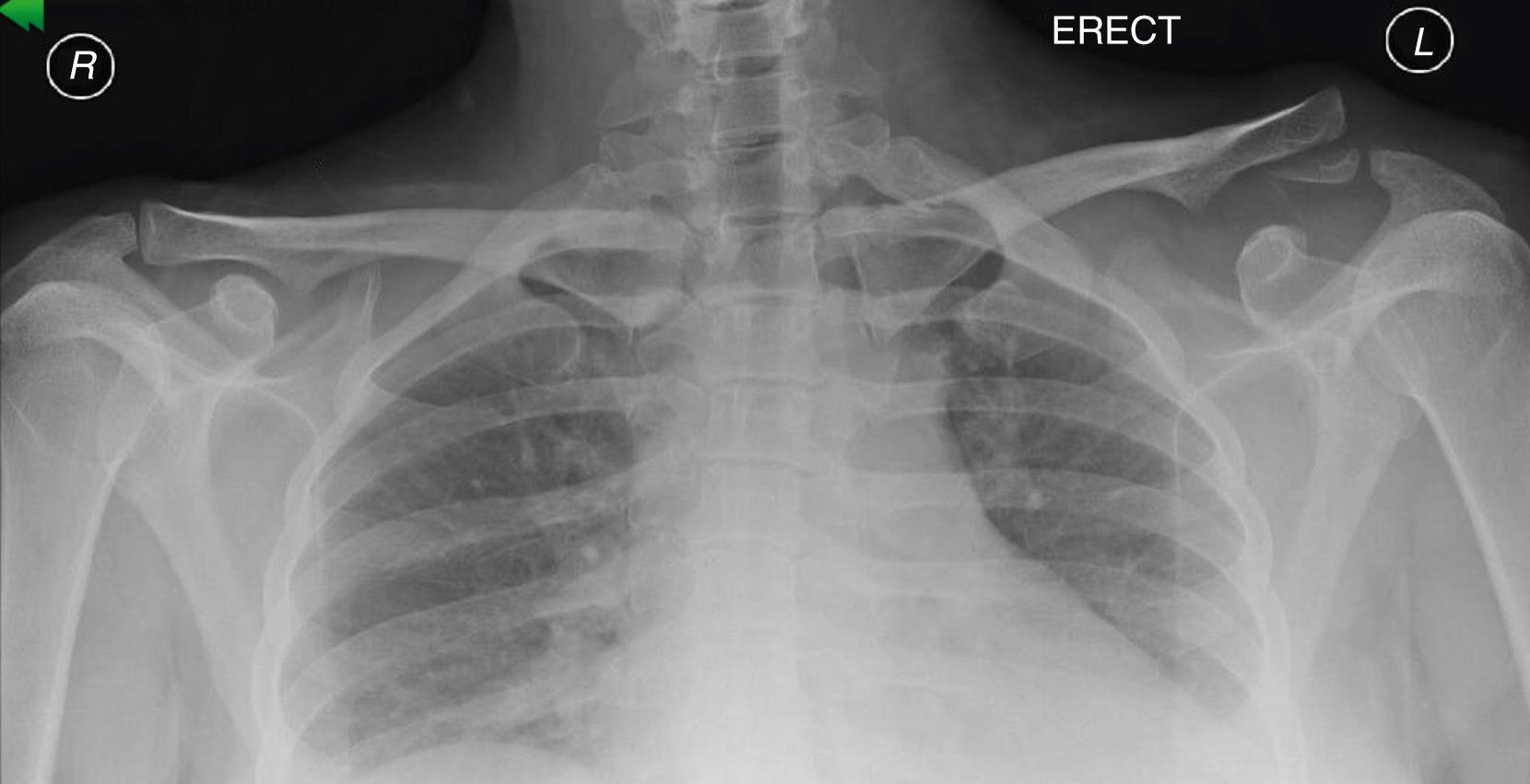 Fig. 10.1, Displaced distal clavicle fracture with coracoclavicular ligament disruption.