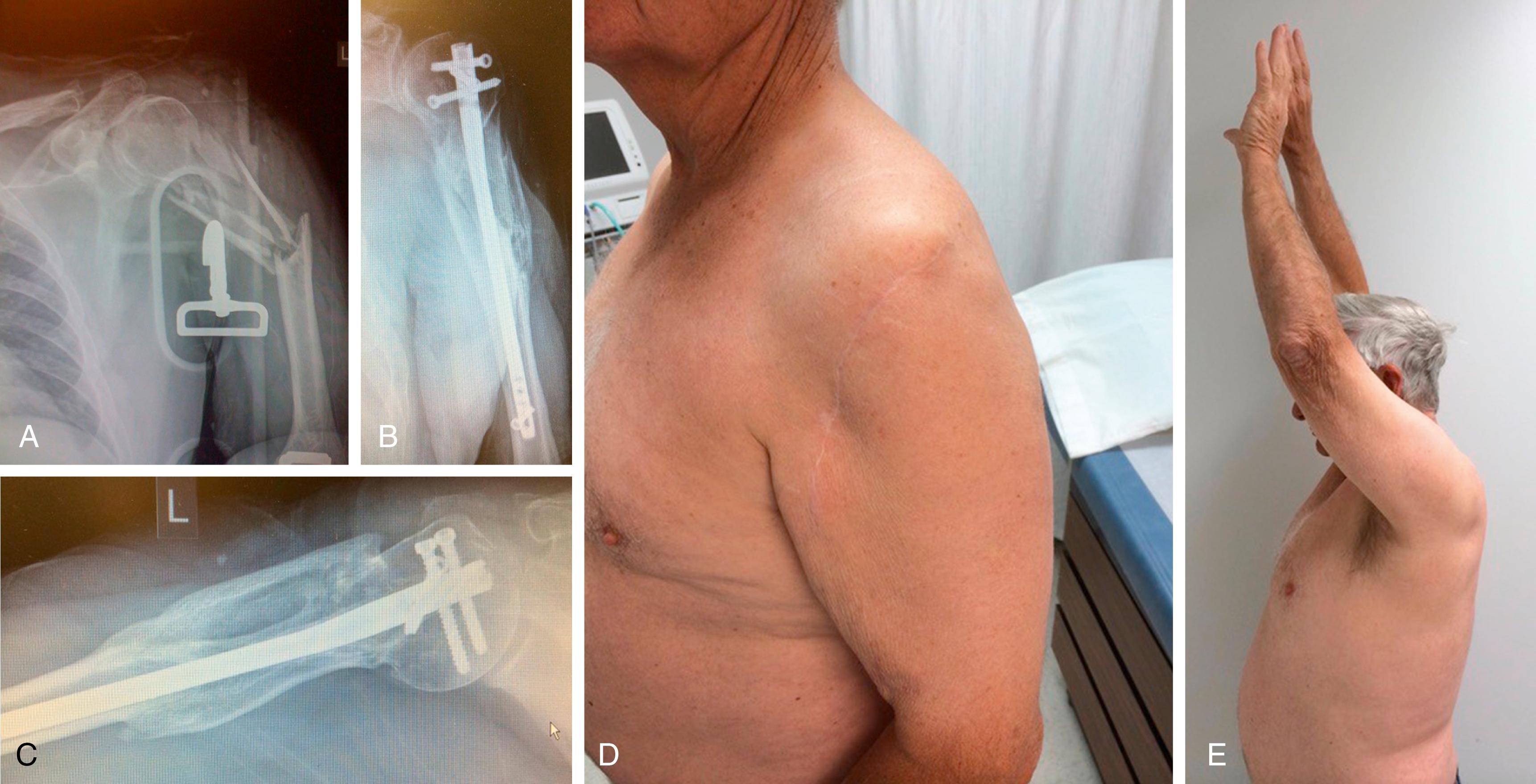 Fig. 35.1, A 62-year-old farmer who was involved in a significant farming accident presented with a Gustilo III open degloving injury and fracture to his humeral shaft. He was treated with urgent open irrigation and debridement and (A) intramedullary fixation and primary soft tissue repair. An intramedullary implant was utilized to bridge the highly comminuted fracture and to avoid placement of hardware into the zone of open injury. (B) and (C) Final anteroposterior and axillary radiographs taken at 3 years from injury demonstrate complete union with a (D and E) well-healed soft tissue envelope and excellent clinical function.