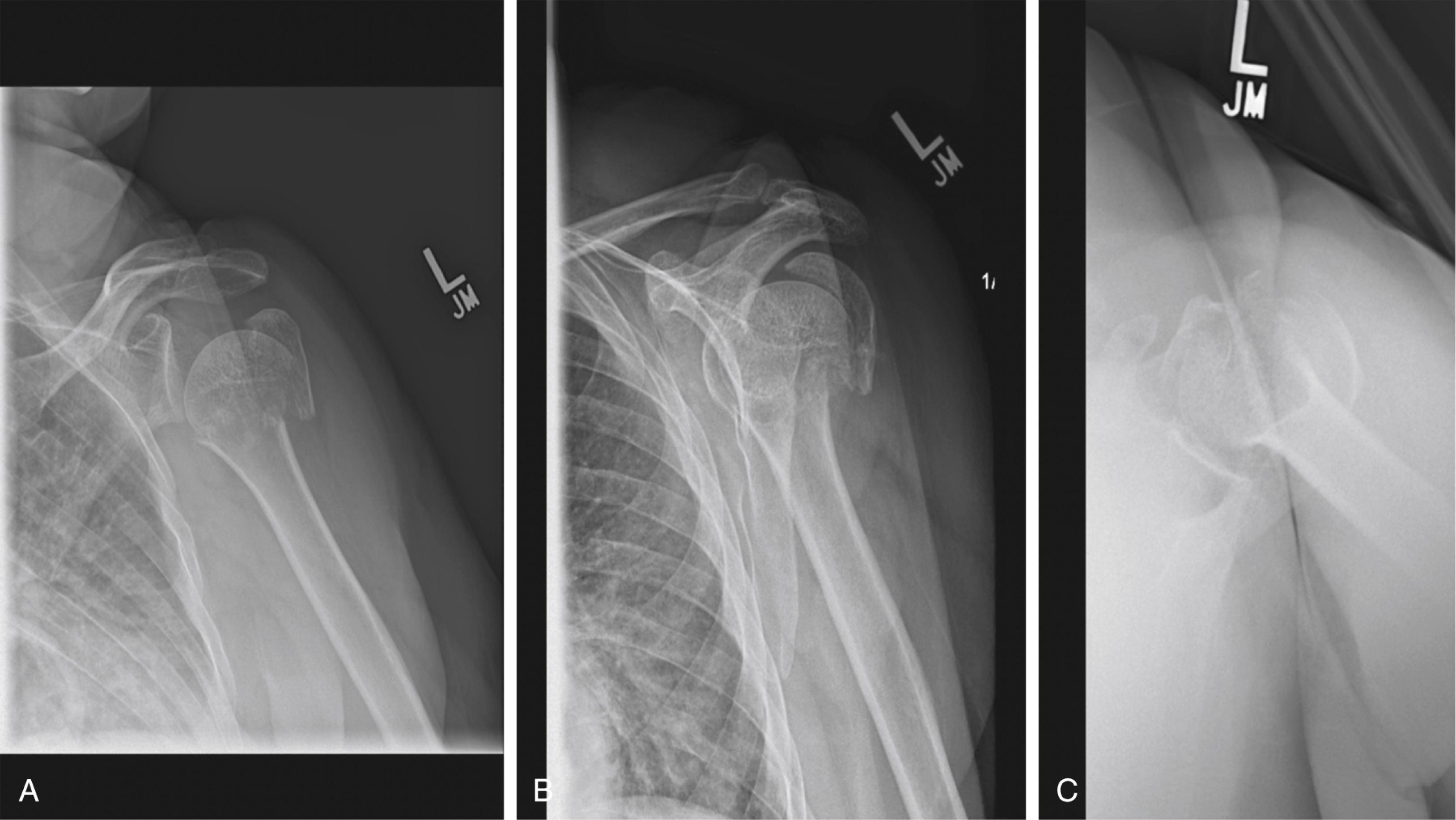 Technique Spotlight: ORIF Proximal Humerus Fracture with Deltopectoral ...