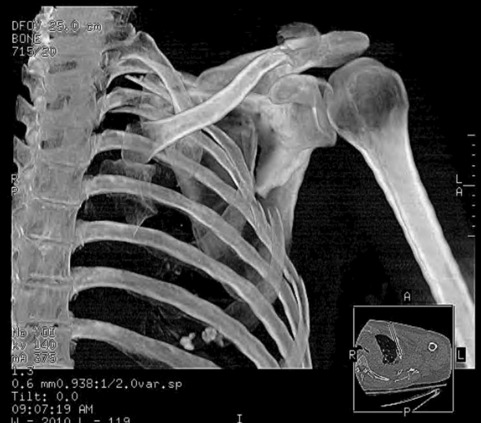 Fig. 16.11, This three-dimensional computed tomography of the left shoulder and thorax helps to reveal a medialized and anteverted glenoid with respect to the caudal body of the scapula. Less obvious is the inferior tilt of the glenoid; however, this deformity can be appreciated by noting the shallow glenopolar angle and understanding what would happen to the face of the glenoid were the lateral border reduced.