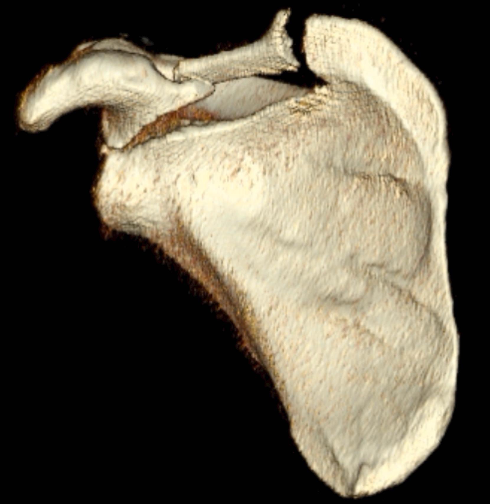 Fig. 16.3, A three-dimensional computed tomography from the anterior scapula shows a coracoid fracture pattern that exits into the glenoid cavity. Often these fractures exit medially through the suprascapular notch putting the suprascapular nerve at risk. These fractures can occur in isolation or in combination with scapular body or neck fractures.