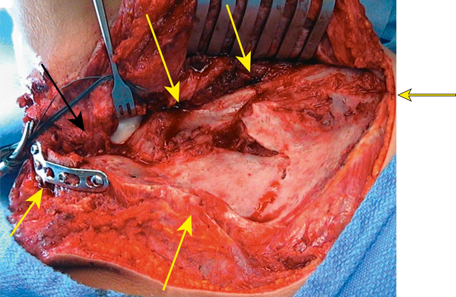 Fig. 16.4, This is an intraoperative image of an extensile Judet approach, in which the infraspinatus, teres minor, and deltoid are mobilized off of the posterior scapular body. This provides maximal visualization, and the flap is elevated on the neurovascular (nv) pedicle. The black arrow is pointing to the suprascapular nv bundle which exits the spinoglenoid notch at the base of the acromion. The acromion, in this case, has already been fixed. This approach was chosen because of the complexity of the fracture pattern with multiple exit points around the perimeter (yellow arrows) . Furthermore, it was 2 weeks from the time of injury and callus formation was inevitable. An arthrotomy has been made through which the humeral head can be visualized. This was done because the patient had a comminuted glenoid fracture and required an anterior approach subsequent to this posterior approach.