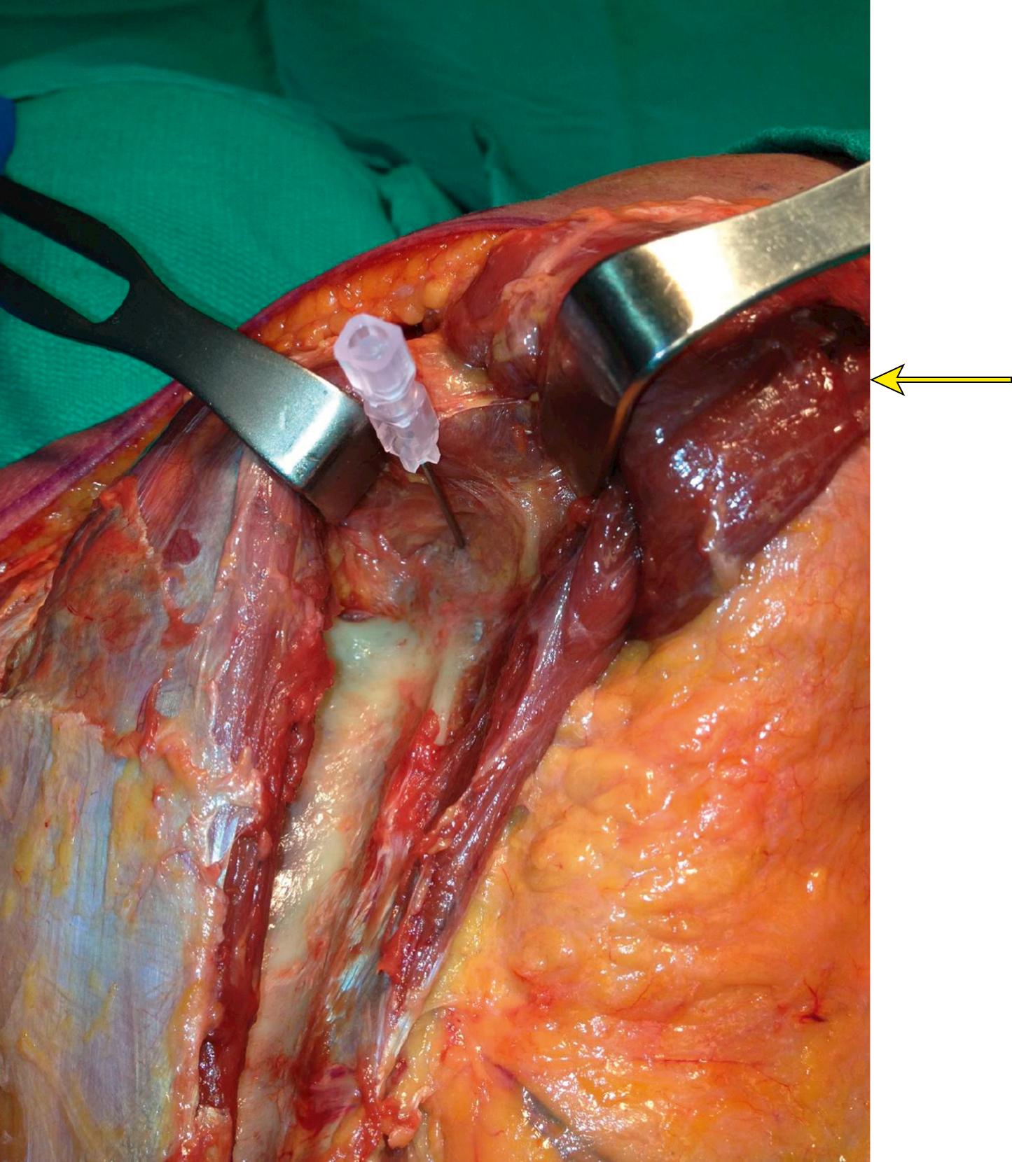 Fig. 16.5, This posterior shoulder dissection shows the exposure to the posterior glenoid and scapular neck through a modified deltoid detaching Judet approach. The IV needle is penetrating the glenohumeral joint and the arm would be to the right side of the picture. The infraspinatus is being retracted medially to the left, and the teres minor and detached deltoid (yellow arrow) is being retracted superiorly and to the right. There is easier access to the posterior glenoid and for intra-articular assessment with the deltoid detached.