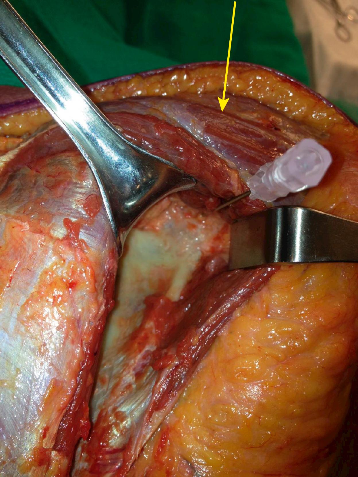 Fig. 16.6, This posterior shoulder dissection shows the exposure to the posterior glenoid and scapular neck through a modified deltoid sparing Judet approach. The IV needle is penetrating the glenohumeral joint and the arm would be to the right side of the picture. The infraspinatus is being retracted medially to the left, and the teres minor is being retracted laterally to the right. The deltoid is intact and sweeping across the cephalad part of the surgical field (yellow arrow) .