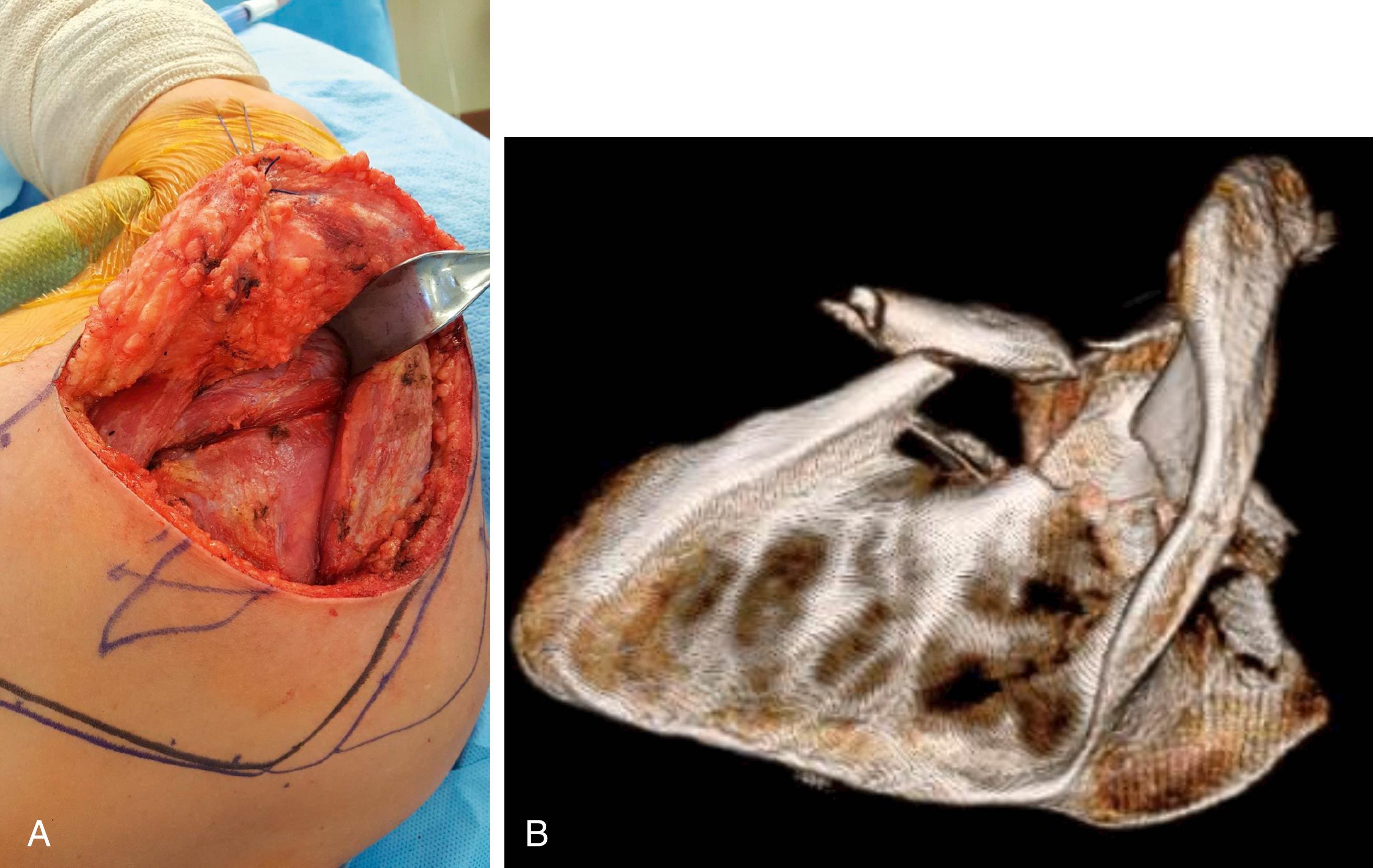 Fig. 16.7, (A) The purpose of this posterior shoulder image is to show the different size of the skin incision, which helps to limit exposure to the lateral scapula for certain fracture patterns that do not exit the vertebral border. The deltoid muscle is being retracted cephalad, exposing the interval between teres minor and infraspinatus. (B) This three-dimensional computed tomography image is an example of a scapular fracture pattern, which would be amenable to such an approach.