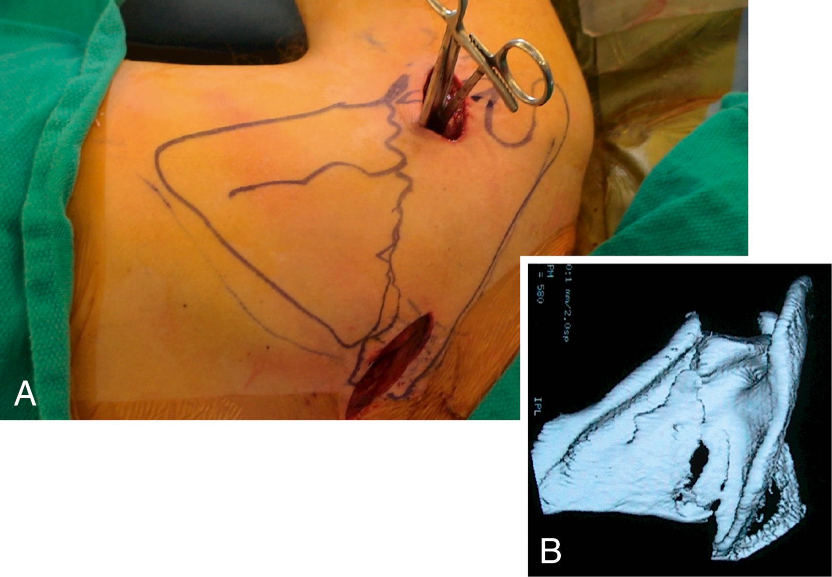 Fig. 16.8, (A) The intraoperative image shows the incisions chosen for a minimally invasive approach which yields windows down to the displaced fracture line. (B) A corresponding simple body fracture on a three-dimensional computed tomography scan, revealing a lot of lateral border offset. The surgeon will approach the two displaced ends of the scapula, medial and lateral, to reduce and fix this pattern.