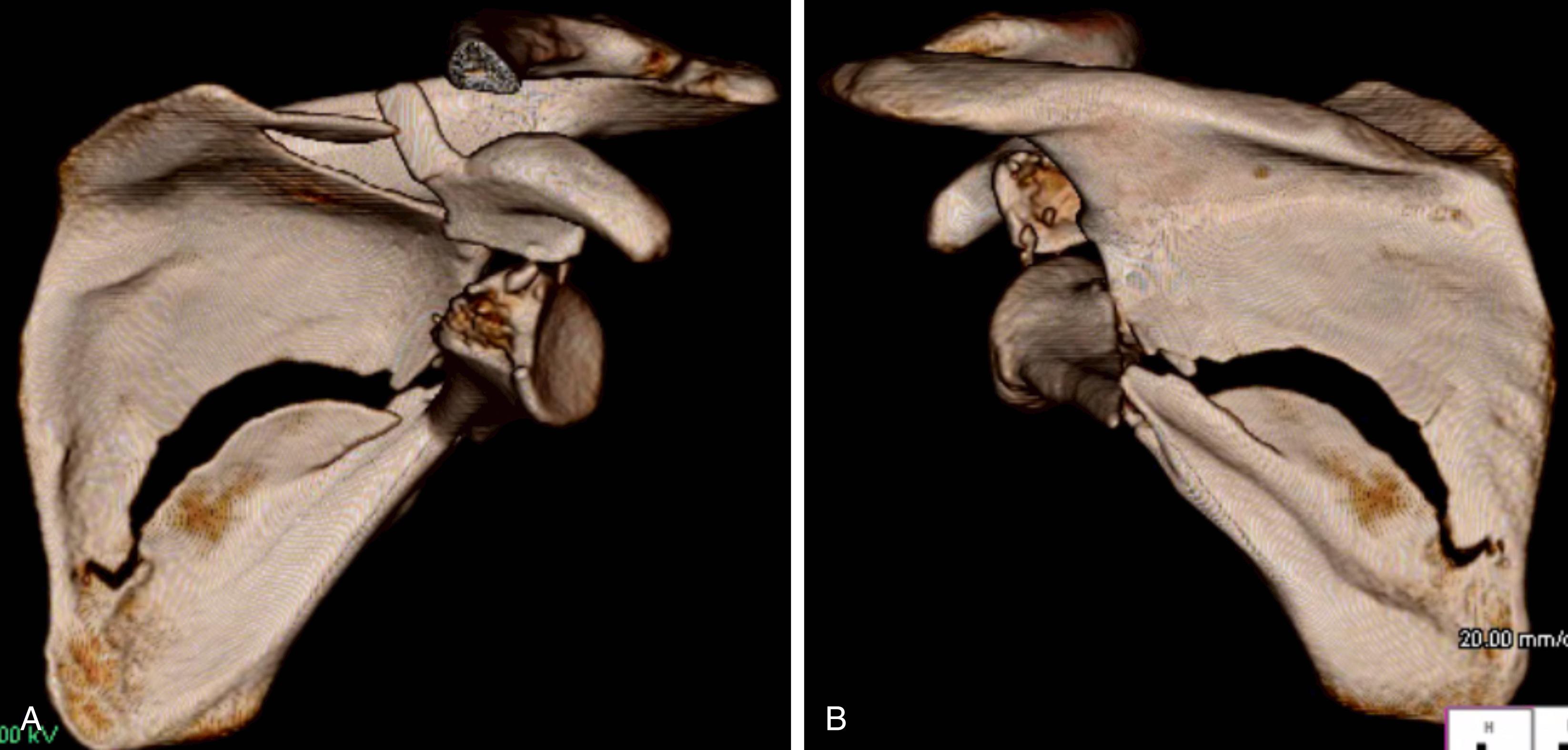 Fig. 16.9, The (A) anterior and (B) posterior three-dimensional computed tomography views demonstrate the need for an anterior approach and a posterior approach to address the pathology. The surgical tactic begins with the posterior approach to restore the lateral pillar and scapular neck. The anterior approach is then required to address the coracoid and glenoid. The surgeon must ensure that no screws from posterior interfere with the reduction and fixation of the coracoglenoid complex.