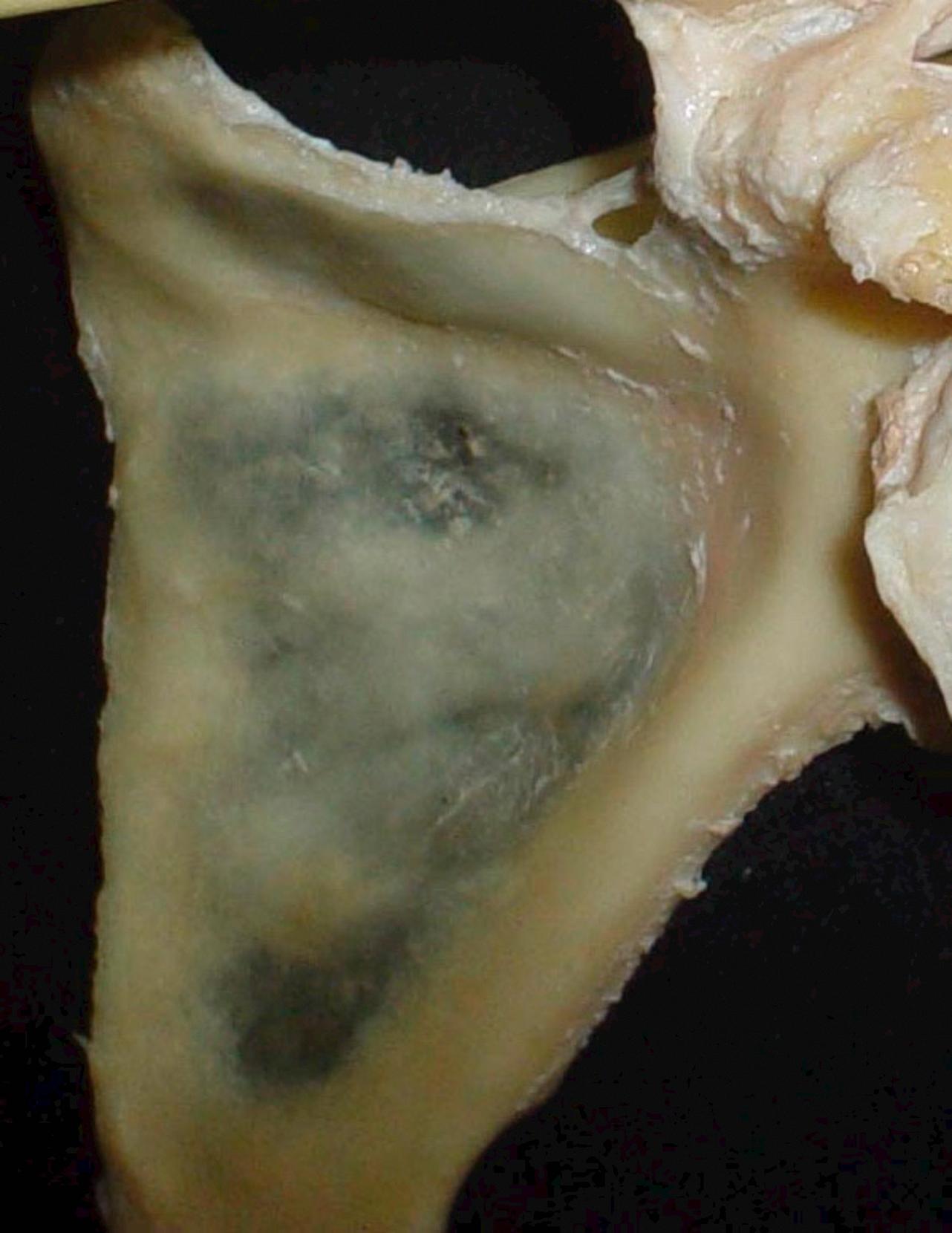 Fig. 16.10, This image is an anterior view of a scapula denuded of its musculature, revealing the bony opportunities for fixation. The vertebral medial border is only approximately 8-mm thick, while the lateral border provides about 14 mm. The glenoid yields approximately 30 mm at the subchondral bone but transitions quickly through the scapular neck to the translucent body.