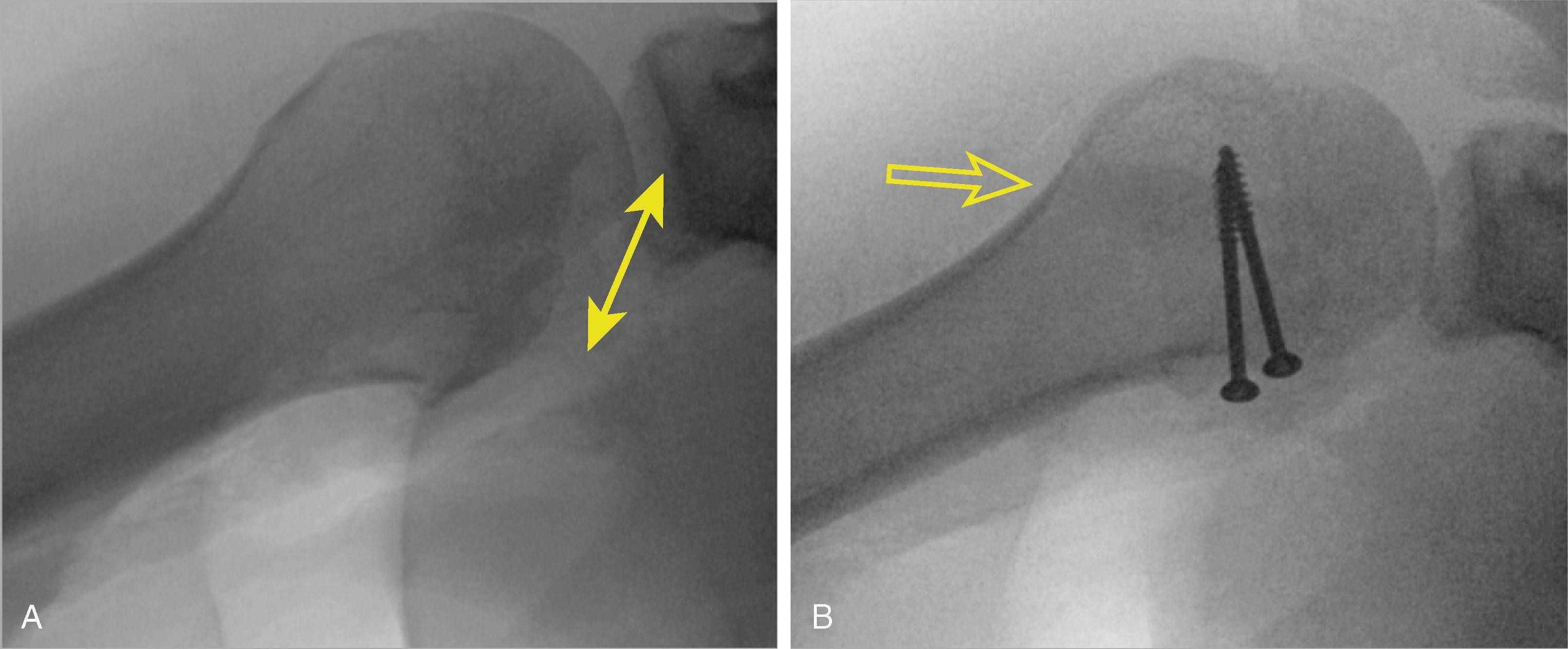 Fig. 24.2, Intraoperative axillary images of a (A) right shoulder immediately after open reduction showing the impacted reverse Hill-Sachs lesion (double arrow) and (B) after anatomic reduction of the articular surface, backfilling with bone graft along the indicated trajectory (arrow) , and placement of rafter screws.