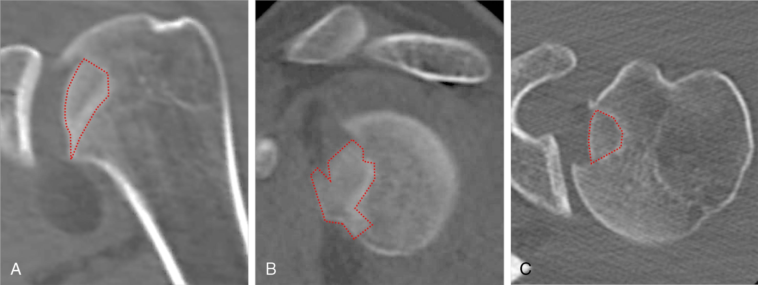 Fig. 24.3, Preoperative (A) coronal, (B) sagittal, and (C) transverse computed tomography of a left shoulder outlining the anterosuperior humeral impaction fracture (red-dotted line) .