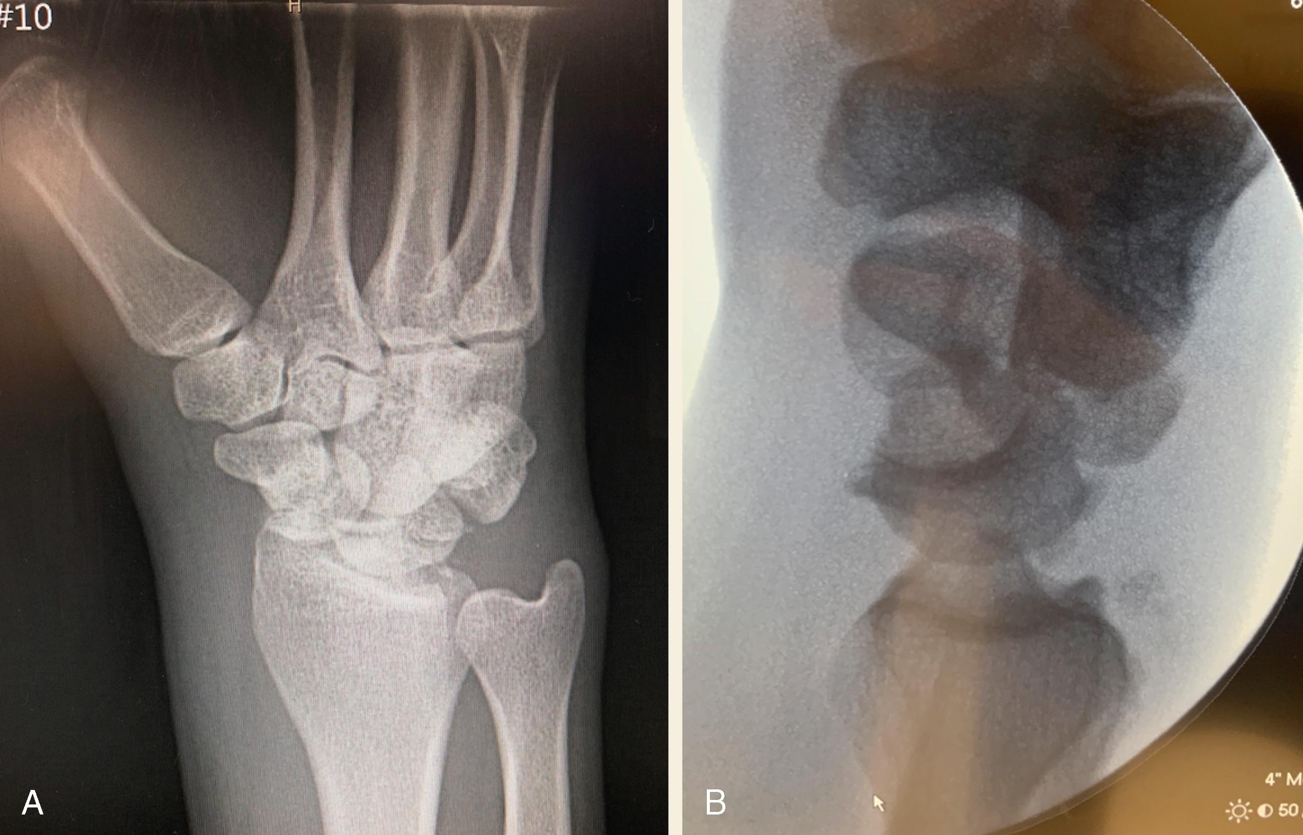 Fig. 73.1, Injury films: A 26-year-old male sustained a fall while skateboarding. Radiographs (A: PA and B: lateral) demonstrate a greater arc perilunate injury through the scaphoid waist, with disruption of Gilula’s lines and rotation of the proximal pole of the scaphoid approximately 90 degrees.