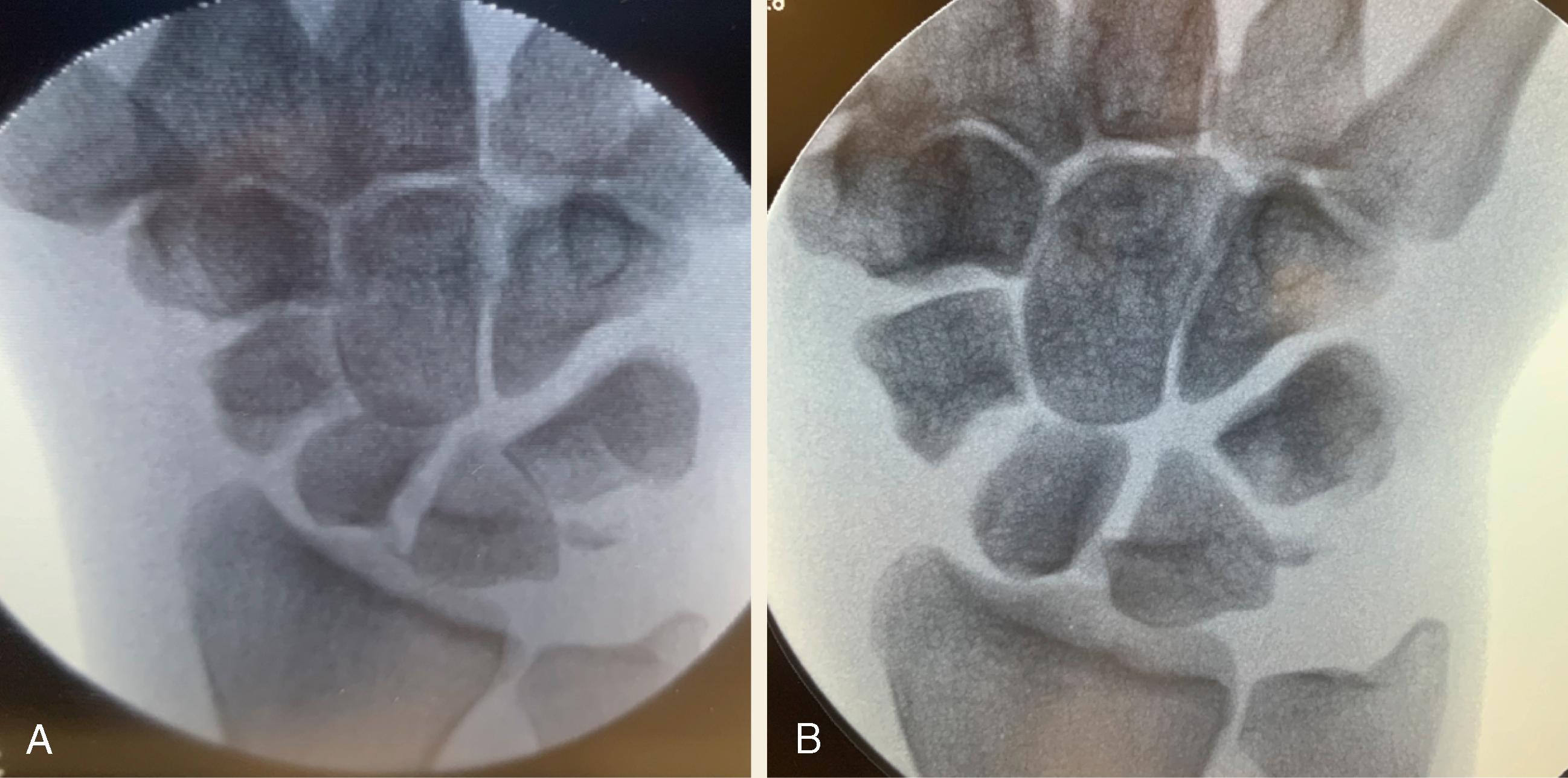 Fig. 73.2, Prereduction fluoroscopic images (A: PA and B: oblique) with rotation of the proximal pole of the scaphoid 90 degrees.