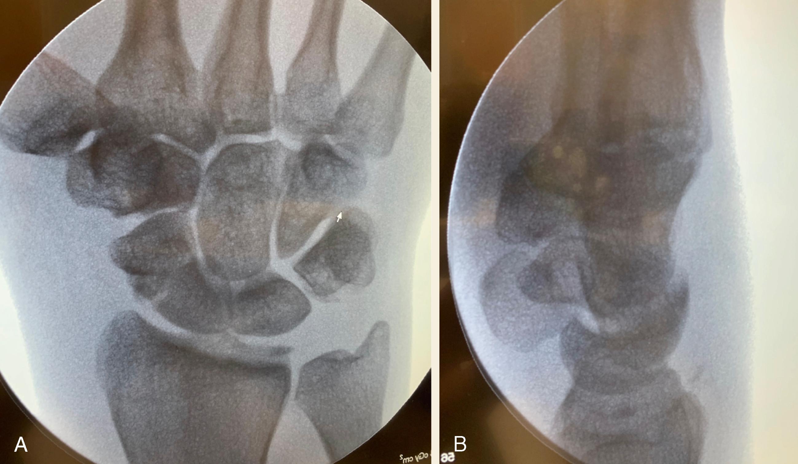 Fig. 73.3, Postreduction fluoroscopic images ((A) PA and (B) Lateral) with restored carpal alignment and reduction of the proximal pole of the scaphoid.