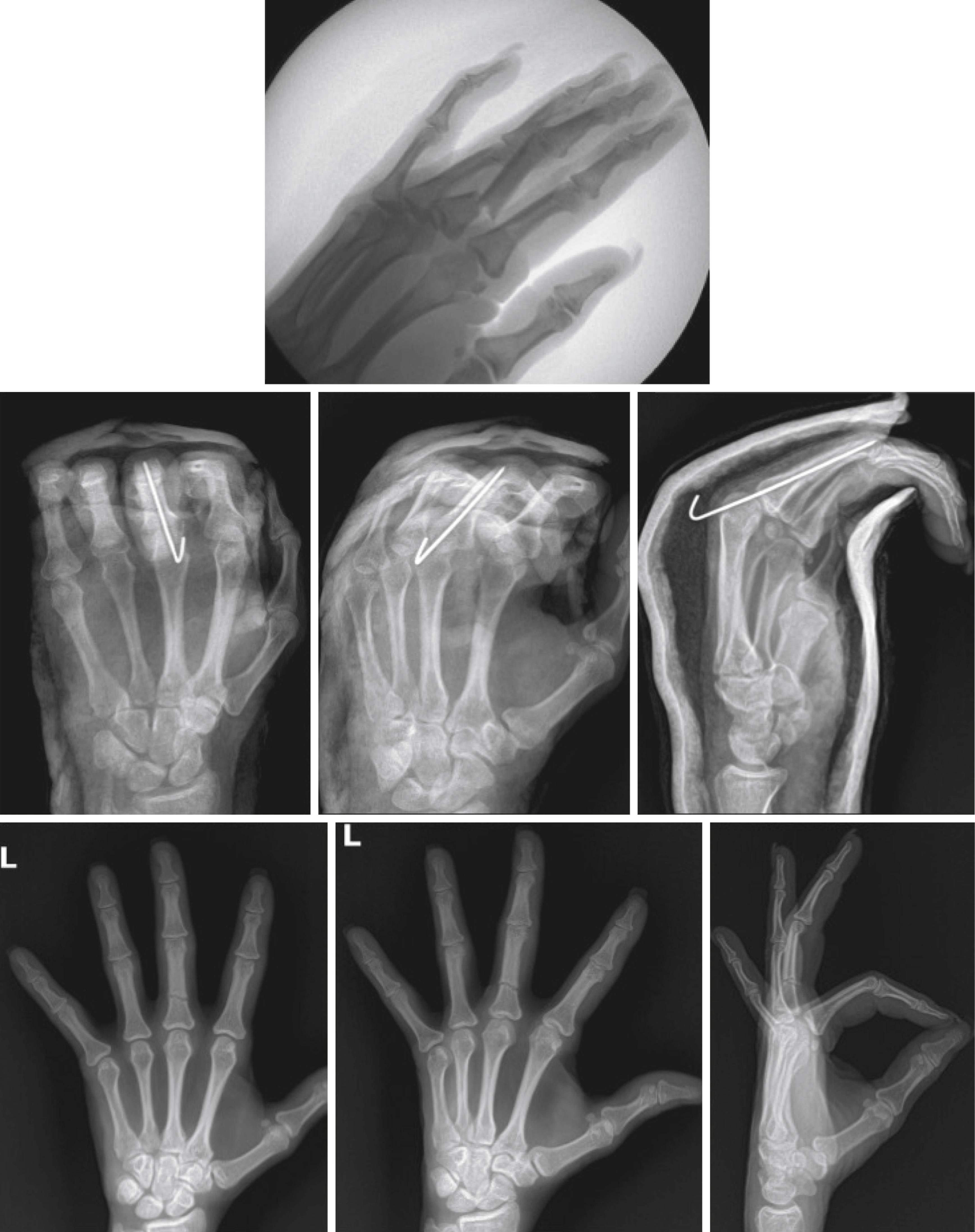 Fig. 79.1, A 48-year-old woman who sustained an extra-articular base fracture of her middle finger proximal phalanx, treated with closed reduction and transarticular pinning (Belsky technique).