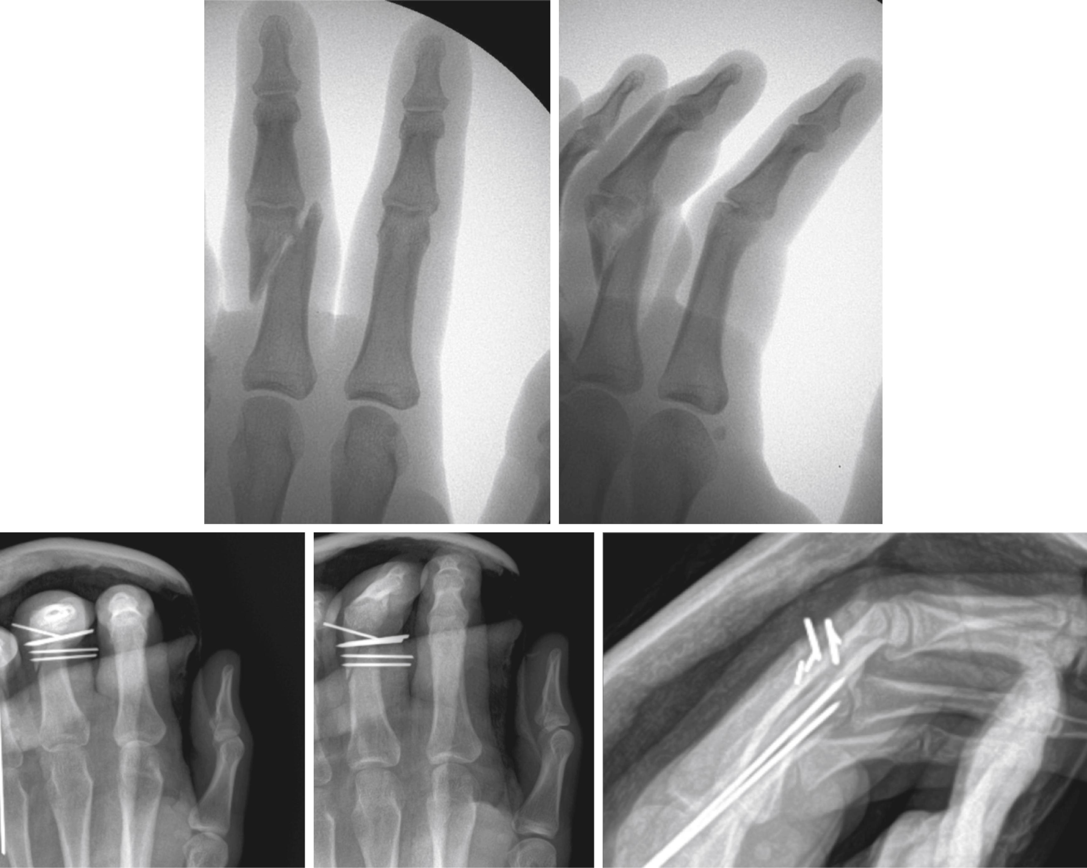 Fig. 79.2, A 24-year-old male who sustained ring and middle finger proximal phalanx fractures treated with closed reduction and percutaneous fixation. The posteroanterior and oblique views best demonstrate multiple K-wires placed perpendicular to the middle finger proximal phalanx. The lateral radiograph demonstrates the ring proximal phalanx fixed with a Belsky pinning technique.