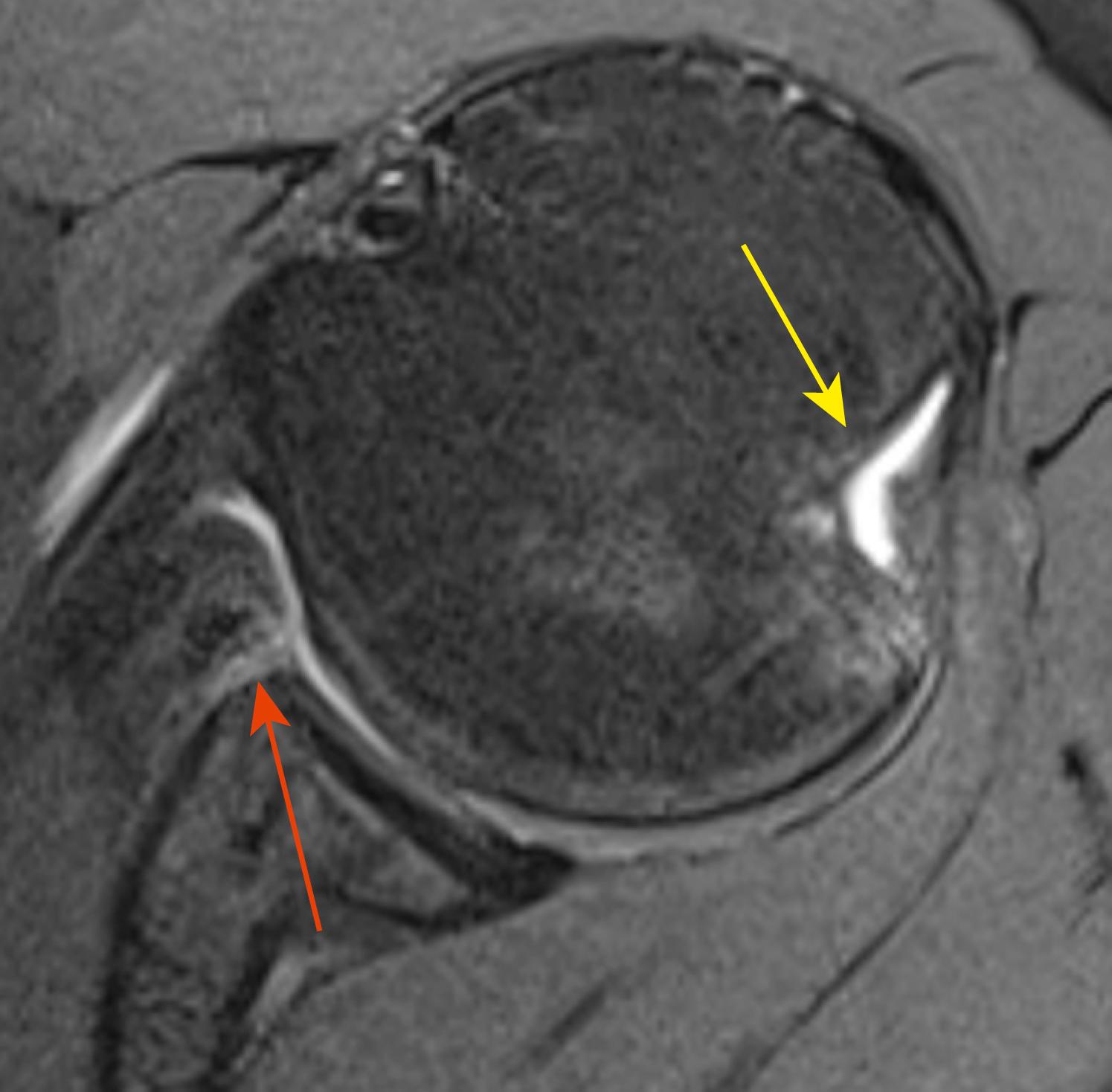 Fig. 21.1, Axial magnetic resonance imaging Hill-Sachs lesion. The red arrow points to the Bankart lesion; the yellow arrow points to the Hill-Sachs lesion.