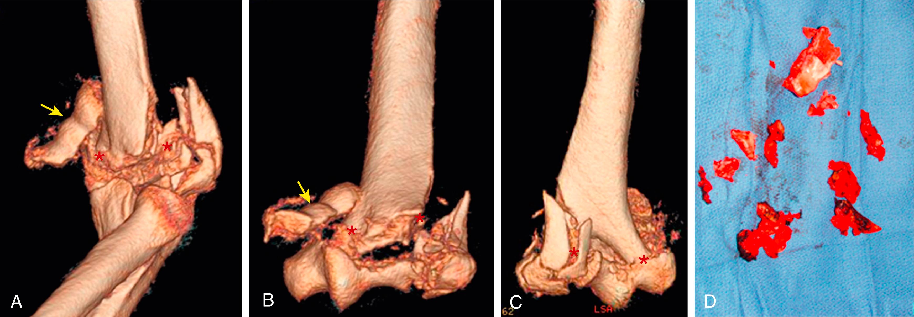 Fig. 38.1, (A) Lateral oblique, (B) anteroposterior, and (C) posterior views of a three-dimensional computed tomography reconstruction shows an unreconstructable distal humerus fractures with multiple comminuted fragments, a complete articular shear (arrow) fracture with little subchondral bone, and supracondylar comminution of both the medial and lateral columns (asterisk) . (D) The intraoperative picture of the multiple comminuted fracture fragments unable to reliably receive fixation.