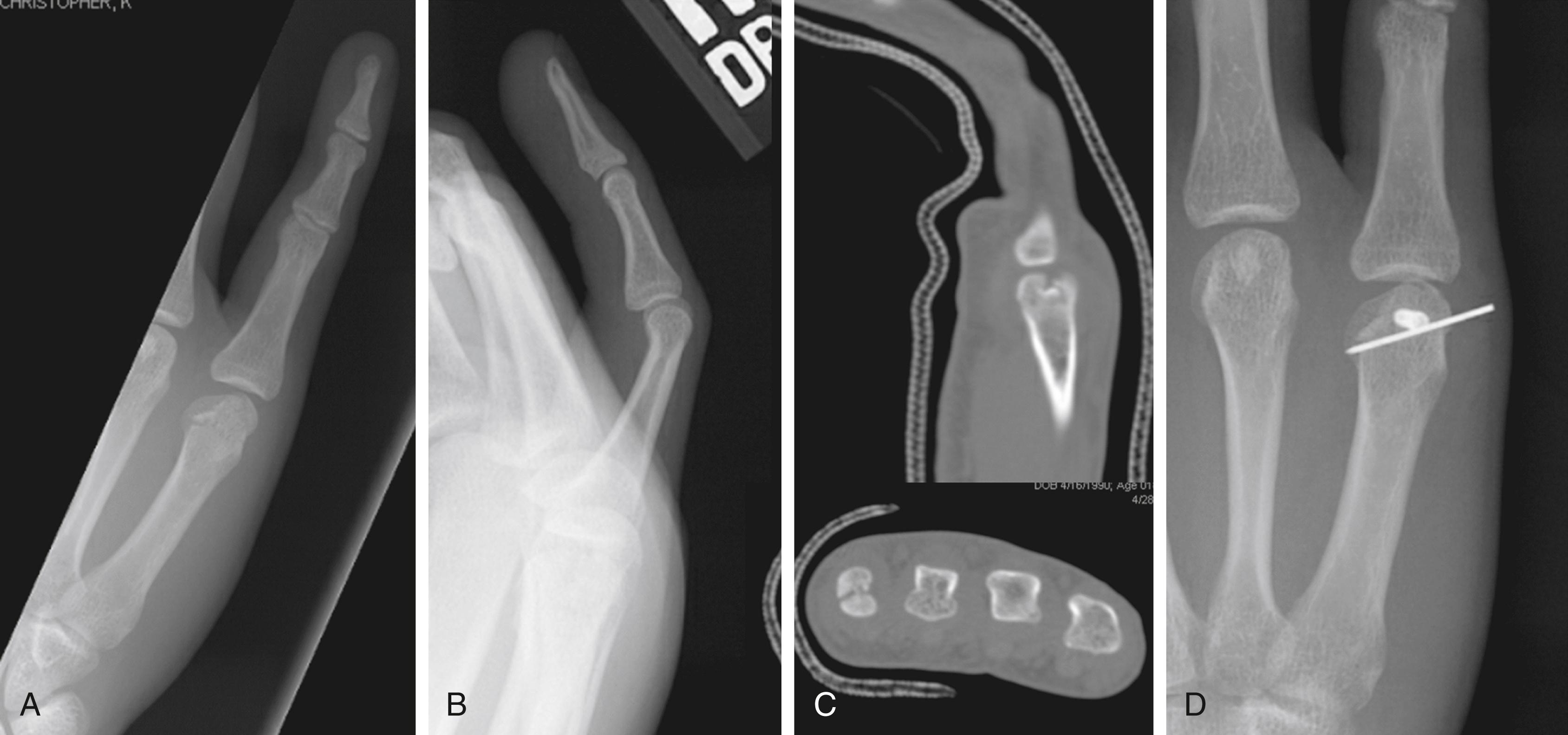 Fig. 76.1, (A and B) Abnormality of the metacarpal head of the small finger raises suspicion of a metacarpal head fracture. (C) Computed tomography scan reveals a displaced, depressed intra-articular fracture. (D) Open reduction and internal fixation was performed.