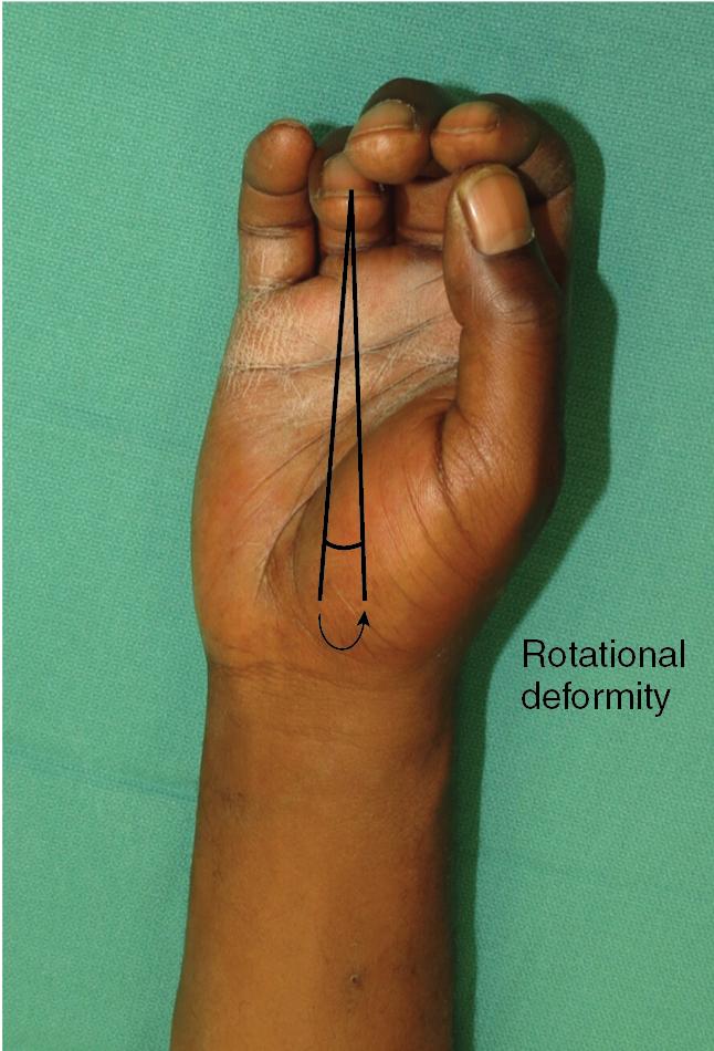 FIGURE 14.1, Clinical assessment of rotational deformity of a fourth metacarpal fracture demonstrating “scissoring.”