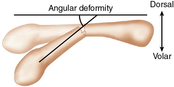 FIGURE 14.2, Apex-dorsal angular deformity.