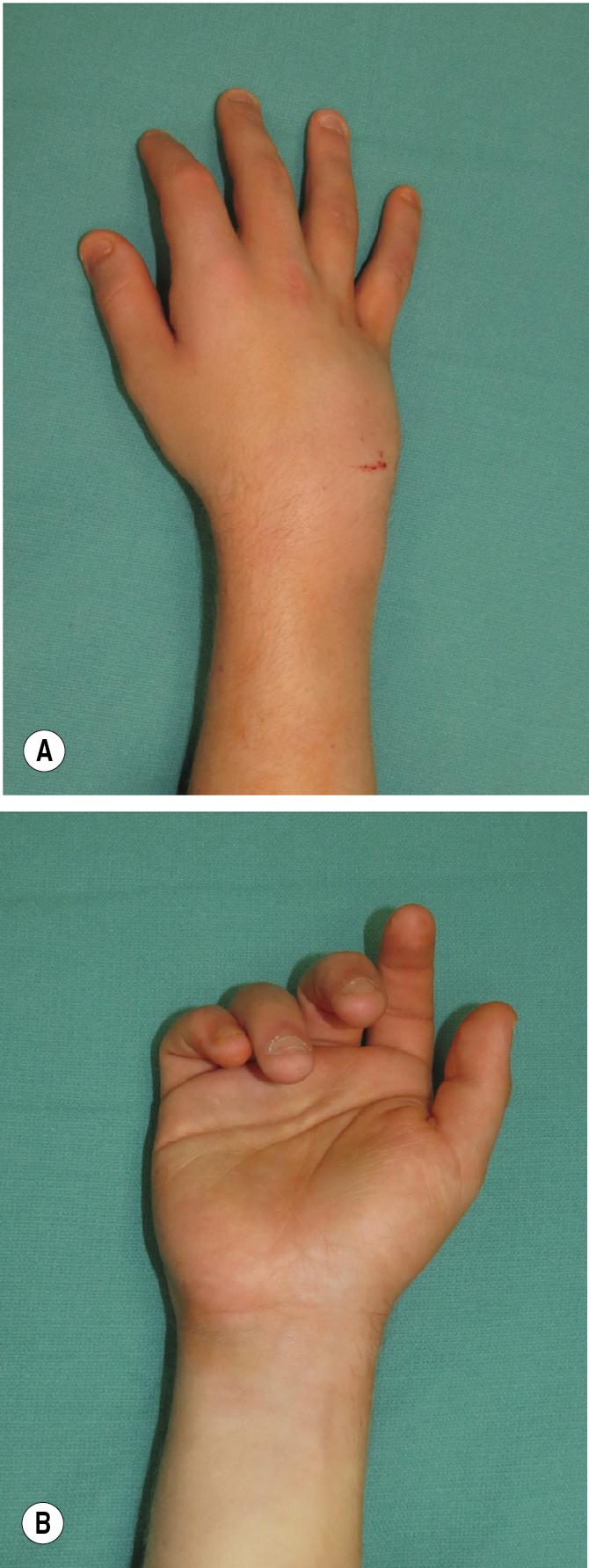 FIGURE 14.3, Swelling of the (A) dorsal and (B) volar hand.