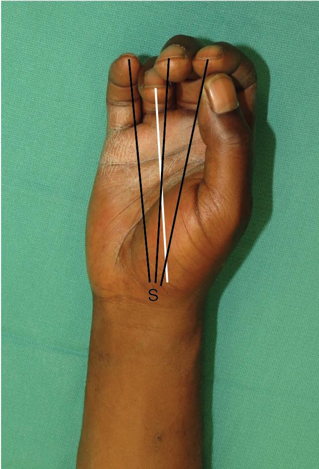 FIGURE 14.4, Assessment of fourth metacarpal rotational deformity. S, scaphoid tuberosity..