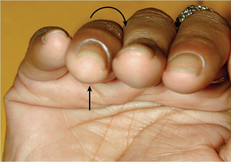 FIGURE 14.5, Subtle rotational deformity in ring finger.