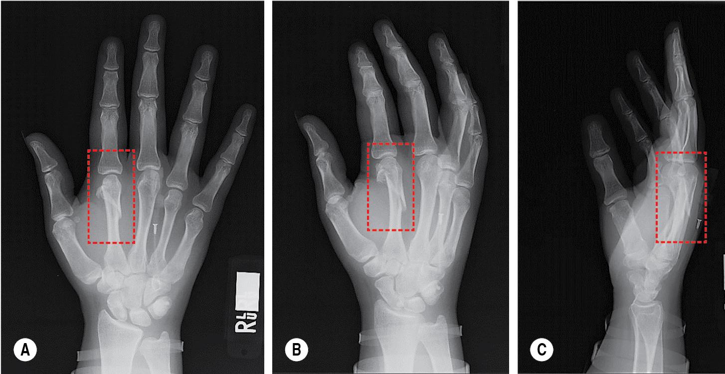 FIGURE 14.6, (A) Posteroanterior [PA], (B) oblique, and (C) lateral radiograph of a second metacarpal fracture.