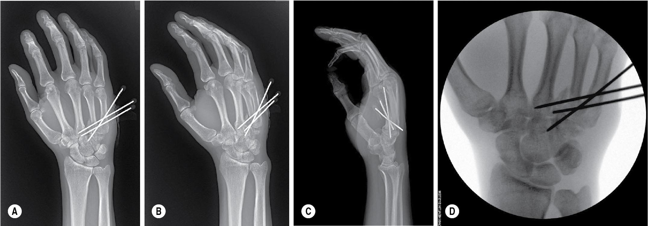 FIGURE 14.8, Postoperative (A) posteroanterior [PA], (B) oblique, (C) lateral radiographs, and (D) intraoperative fluoroscopic image demonstrating K-wire fixation of a fourth metacarpal fracture.