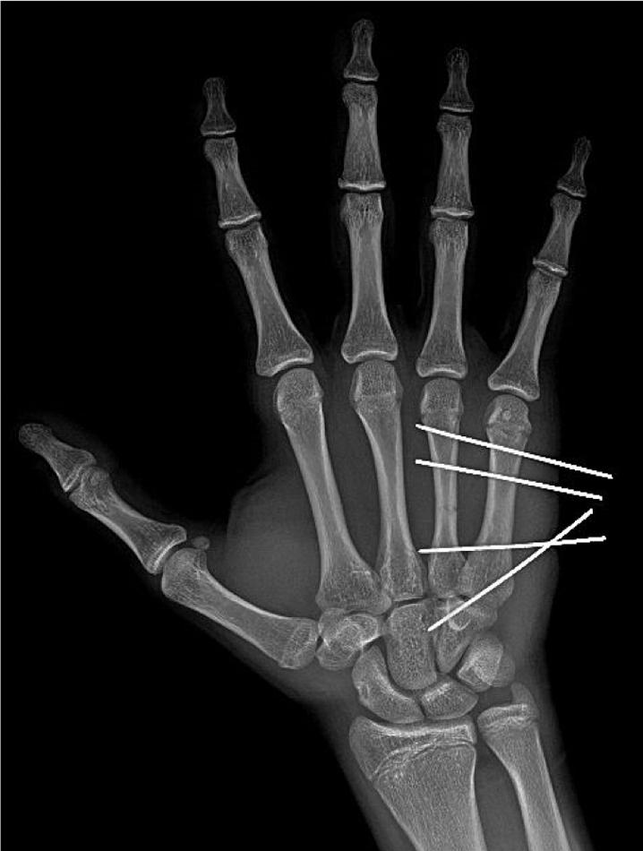 Techniques and fixation of metacarpal fractures - Clinical Tree