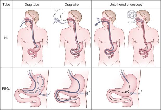 FIG 42.1, Prioritizing techniques for enteral access. Dragging a tube into place increases the chance for proximal displacement when the scope is withdrawn. Dragging a wire is better, but torsion on the wire still impedes endoscopy. “Untethered” endoscopy techniques allow placement of a wire and then delivery of the tube over that wire directly into the small bowel without the need to drag either into place using the endoscope. NJ, nasojejunal; PEGJ, percutaneous endoscopic gastrojejunostomy.