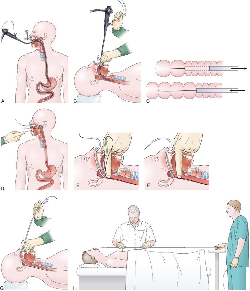 FIG 42.2, Over-the-guidewire endoscopic nasoenteric tube (ENET) technique. A, The pediatric colonoscope is passed down below the ligament of Treitz and the wire extended out beyond the end of the scope. B, In the initial wire transfer, the scope is withdrawn out from the mouth at the same rate the guidewire is passed down through the operating channel, to prevent displacement of the wire tip from its position in the small bowel. C, The keyhole technique is used for withdrawing the endoscope off the guidewire. With the bowel pleated on the end of the endoscope, the endoscope is withdrawn 5–6 cm. By quickly pushing the endoscope back in 2–3 cm, the bowel comes off the end of the endoscope 1–2 folds at a time. D, With the wire protruding out through the mouth, the tip of the wire is then passed through the oronasal transfer tube. E and F, The index finger is then used to pin the wire against the posterior pharyngeal wall while traction is placed on the wire protruding out through the nose, pulling on the wire until the wire is straight and tension is felt against the finger in the posterior pharynx. G, In one technique for the final wire transfer, the feeding tube is passed over the wire down through the nares at the exact same rate that the wire is withdrawn out from the distal end of the feeding tube, again to avoid displacing the wire tip. H, In an alternative technique for the final wire transfer, an assistant pins the wire to a “point in space” (using a bedside table), and the tube is then slid over the fixed wire into final position.