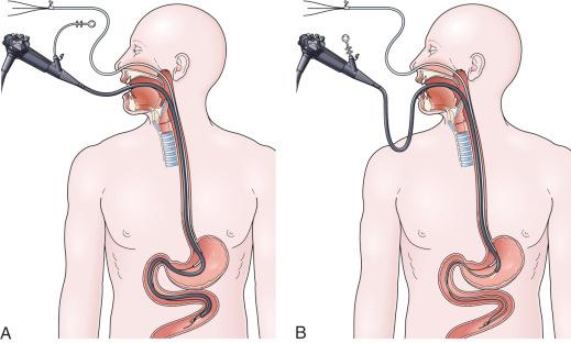 FIG 42.3, Drag and pull endoscopic nasoenteric tube (ENET) technique. A, The feeding tube is stiffened with three guidewires and then passed into the stomach, where one of the three guidewires is passed out beyond the end of the feeding tube. This one wire is grabbed with biopsy forceps and the pediatric colonoscope drags the wire down below the ligament of Treitz. B, As the endoscope is withdrawn back into the stomach, the biopsy forceps are pushed out to hold the wire in position below the ligament of Treitz. With the endoscope still positioned in the stomach, the feeding tube is advanced over the wire until it meets the biopsy forceps at the distal end. The endoscope is then withdrawn out through the mouth before all the guidewires are removed.
