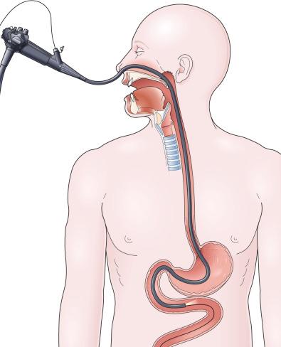FIG 42.4, Transnasal endoscopic nasoenteric tube (ENET) technique. After first placing biopsy forceps down through the operating channel to stiffen the endoscope, a small-caliber (< 6-mm diameter) gastroscope is passed through the nares down into the stomach and beyond the pylorus. A guidewire is passed through the operating channel out beyond the end of the endoscope, and then the endoscope is subsequently withdrawn. The final feeding tube is passed over the wire.