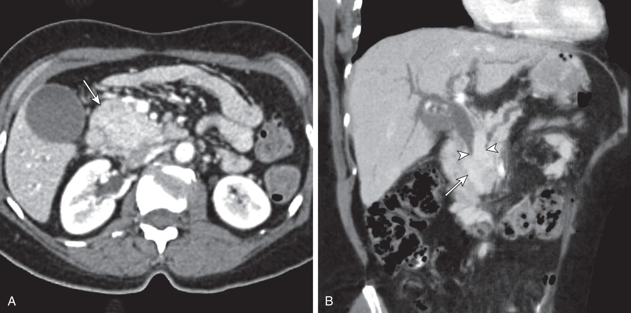 FIGURE 100.1, A 57-year-old female with history of pancreatic adenocarcinoma. (A) Axial computed tomography image of the abdomen obtained in the venous phase demonstrates a large mass in the region of the head of the pancreas (arrow) . (B) Minimum intensity projection in the coronal plane better demonstrates the pancreatic mass (arrow) , resulting in a “double duct” sign (arrowheads) .