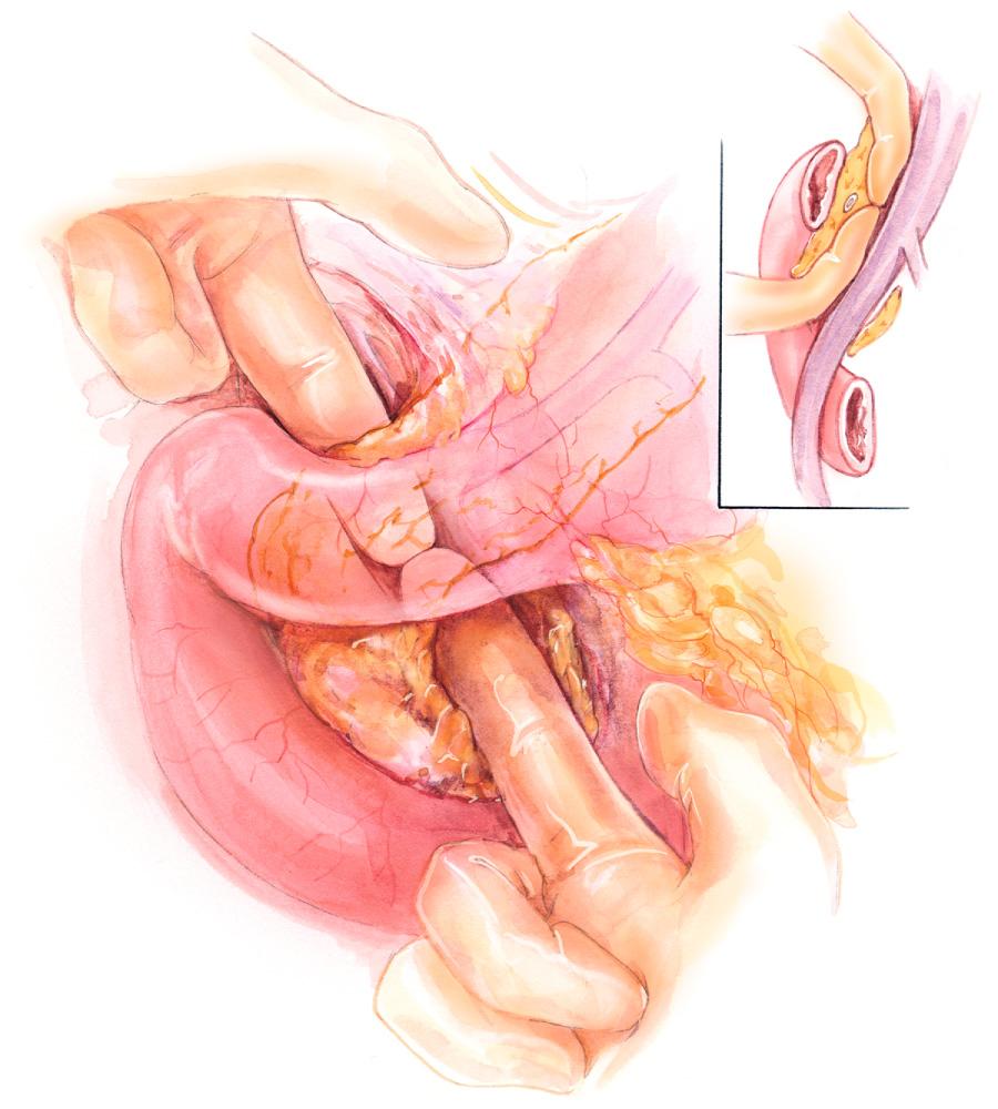 FIGURE 100.2, Creation of the tunnel behind the neck of the pancreas with cephalad dissection off the anterior surface of the superior mesenteric vein avoids venous branches and ultimately clears a plane anterior to the portal vein and superior mesenteric vein, posterior to the neck of the pancreas.