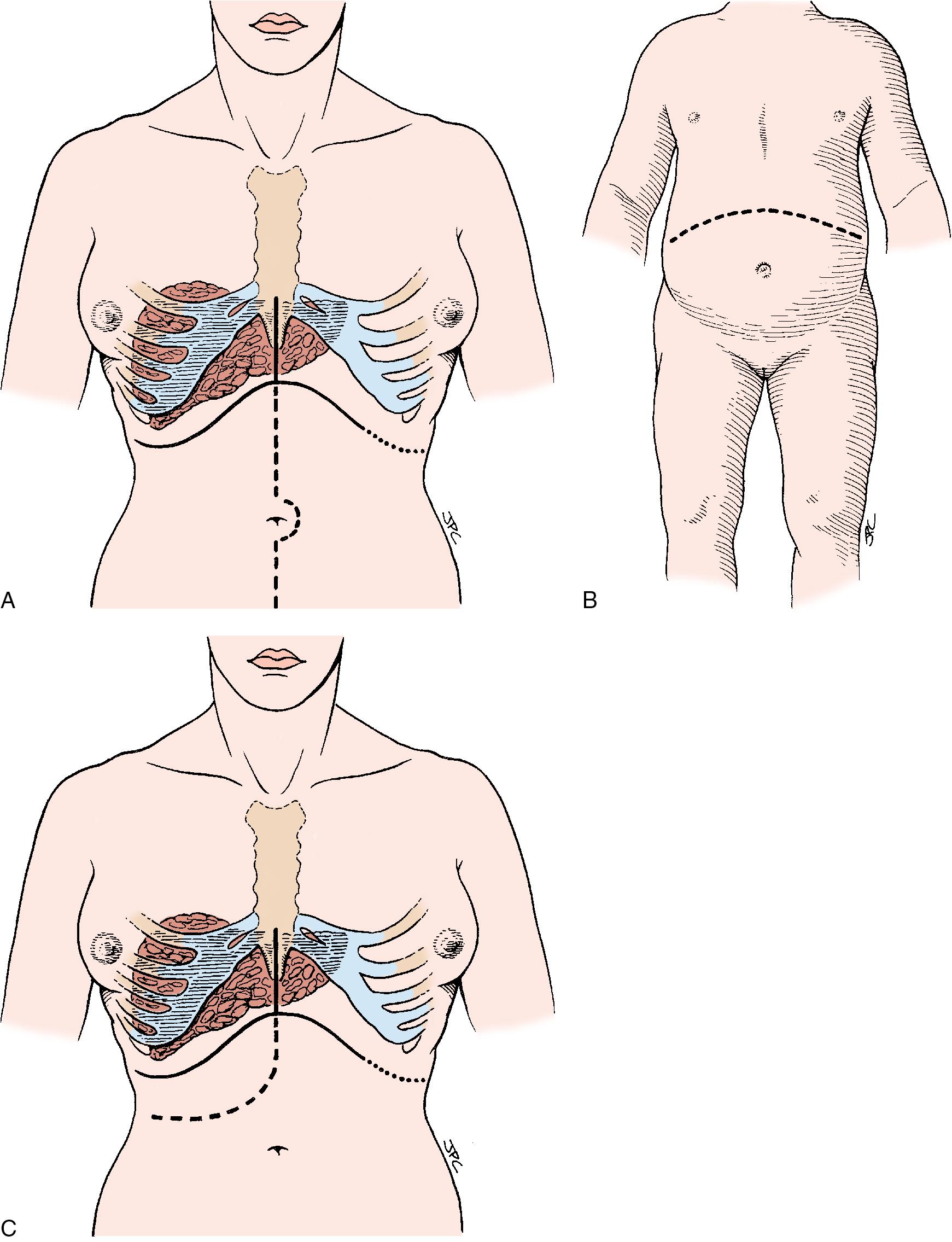 FIGURE 125.11, Potential incisions for orthotopic liver transplantation.