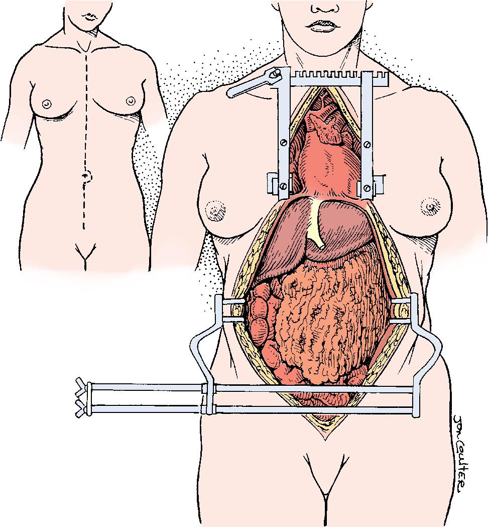 FIGURE 125.2, Exposure for multiple organ retrieval in the deceased donor.