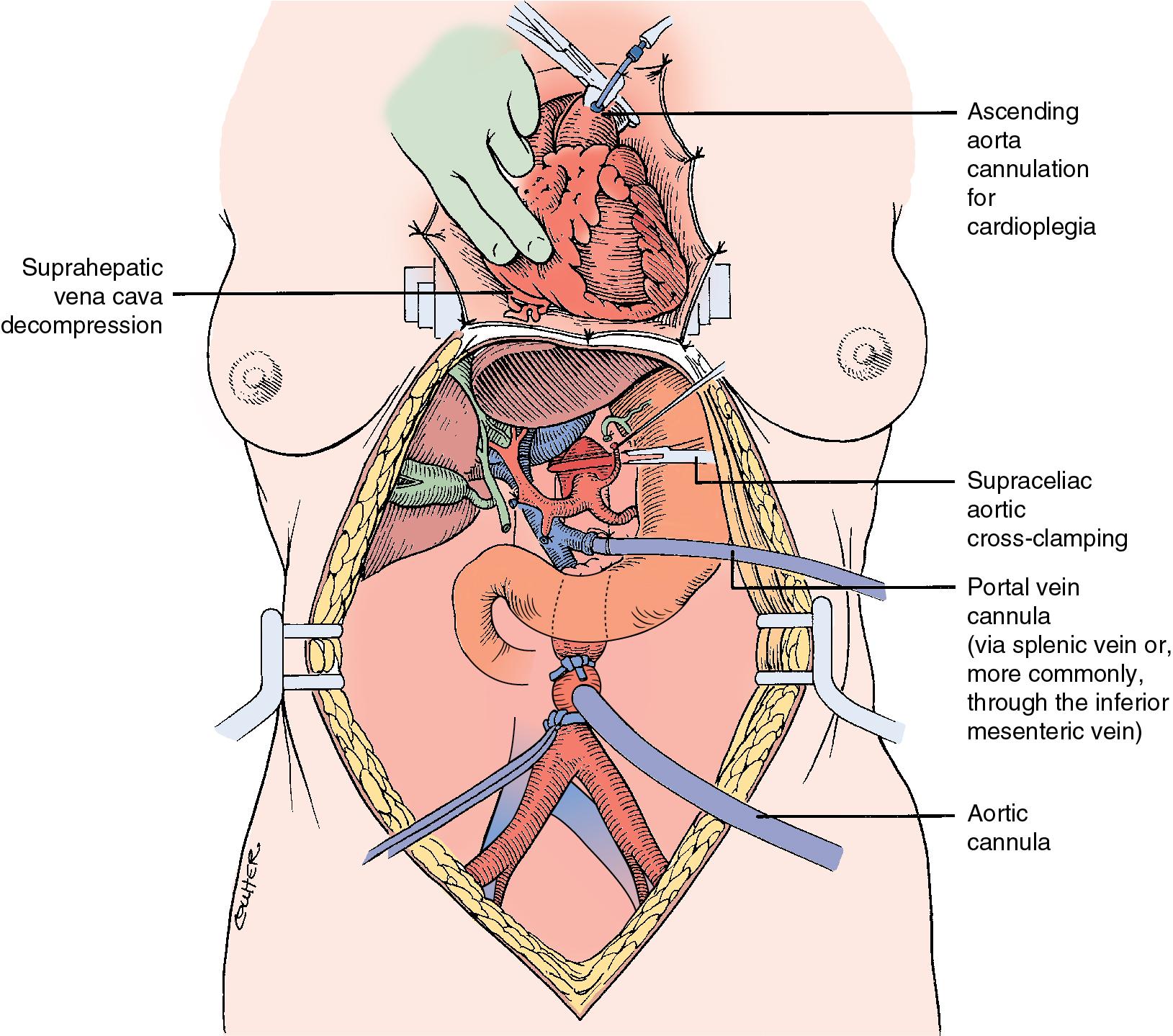 FIGURE 125.4, In situ perfusion technique used when the heart, kidneys, liver, and other viscera are removed from the same donor. University of Wisconsin (UW) or histidine-tryptophan-ketoglutarate (HTK) preservation solution is infused into the inferior mesenteric vein or splenic vein and distal aorta with simultaneous venting of the suprahepatic inferior vena cava into the pericardium. Note the aortic cross-clamp above the celiac axis. The cannulation and cross-clamping of the thoracic aorta for infusion of a cardioplegia solution also are shown (see Chapter 109 ).