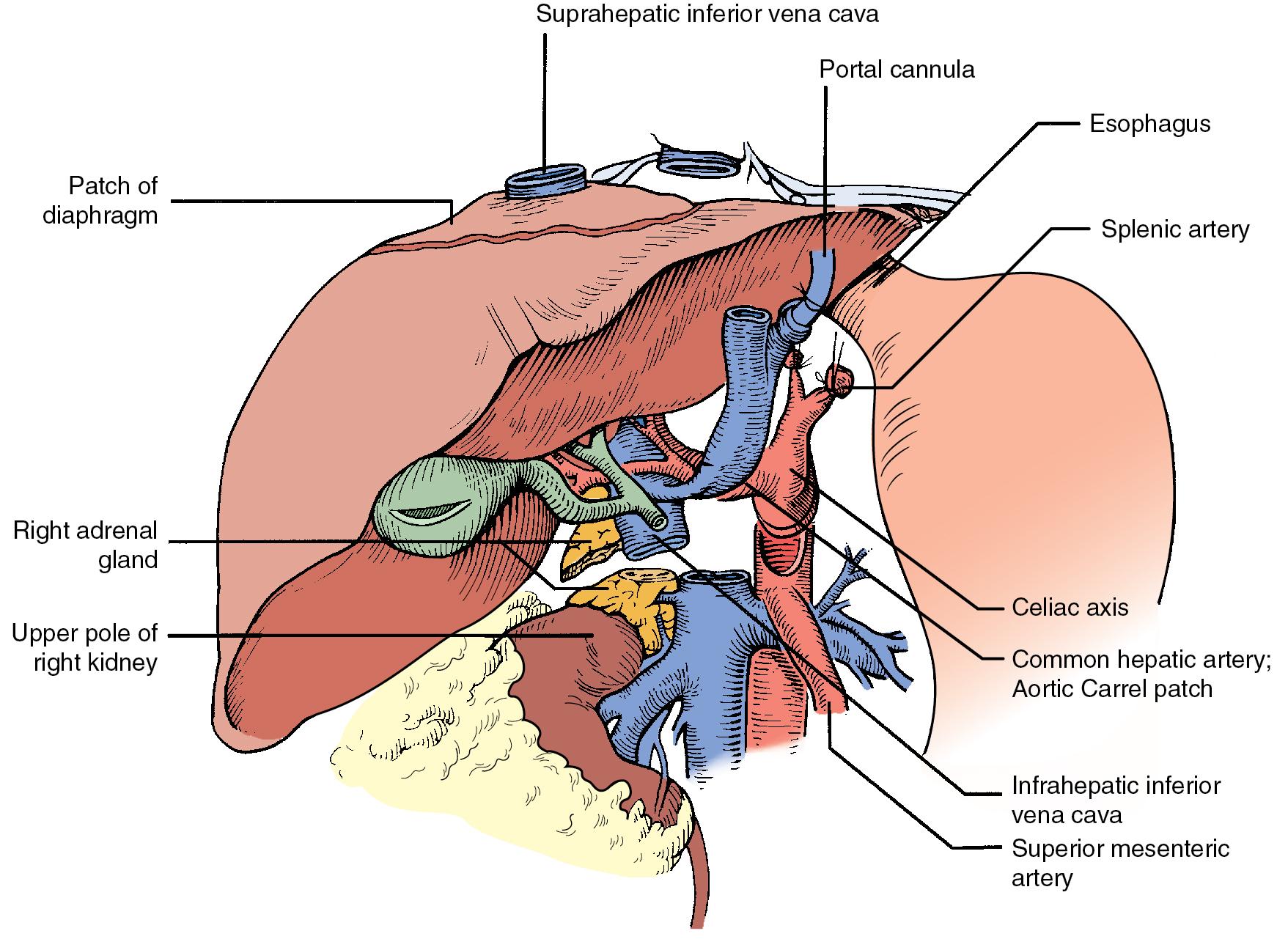 FIGURE 125.6, The suprahepatic vena cava has been transected, with inclusion of a generous patch of diaphragm on the liver side. The infrahepatic vena cava is divided just above the origin of the renal veins, and the celiac axis is removed with a Carrel patch of anterior aorta. If an anomalous right hepatic artery originates from the superior mesenteric artery (SMA), the origin of the SMA may be included in the Carrel patch (see also Fig. 125.10 A).