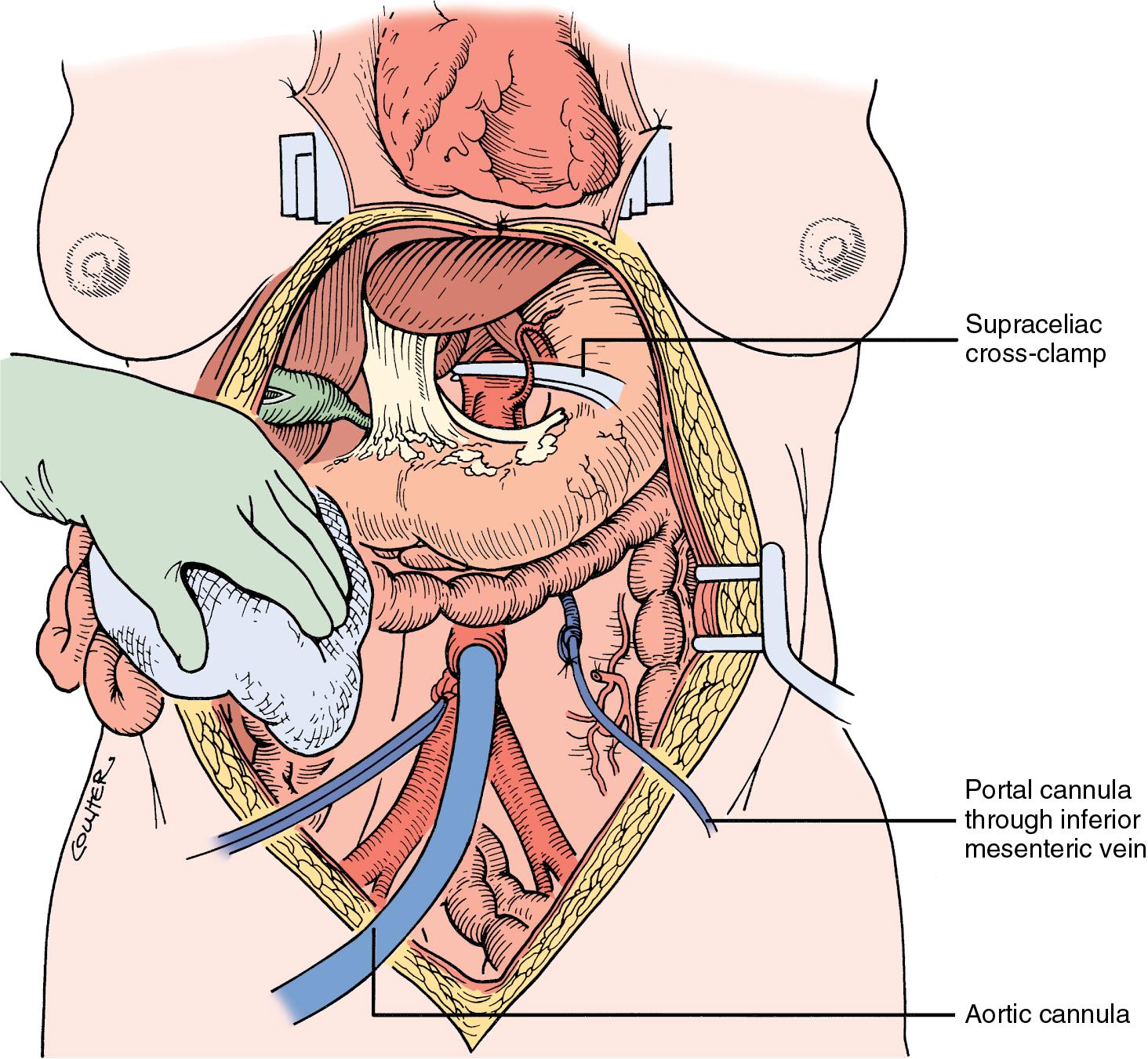 FIGURE 125.8, Rapid technique of organ retrieval in which the initial dissection is limited to the exposure needed for the insertion of perfusion cannulae in the inferior mesenteric vein and distal aorta. If only the abdominal organs are to be used, the aorta can be cross-clamped above or below the diaphragm.