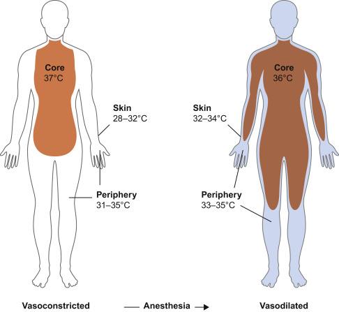 Fig. 13.4, The periphery may be 3°C cooler than the core, but body temperature is maintained because of vasoconstriction. With general anesthesia, the vasoconstriction is reduced, leading to mixing of warm core blood with the cooler blood from the periphery. Hypothermia after induction of spinal or epidural anesthesia shows similar results, but redistribution is restricted to the legs.