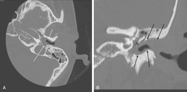 Fig. 5.1, On the axial (A) and coronal (B) multislice CT images obtained through the left temporal bone in a patient with otomastoiditis obliteration of the external ear canal ( arrows ) is also seen: external otitis.