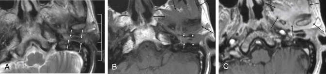 Fig. 5.2, On the axial T2- (A) and T1-weighted (T2WI) (B) images of the left temporal bone in a diabetic patient opacification is seen in the external ear ( white arrows in A and B ), as well as infiltration of the left temporomandibular joint and masticator space ( black arrows in B ), with loss of the normal fat planes between the muscles of mastication. The T1WI after intravenous injection of gadolinium (C) shows strong enhancement of the infiltration in the masticator space ( black arrows in C ). The diagnosis of necrotizing external otitis can be made.