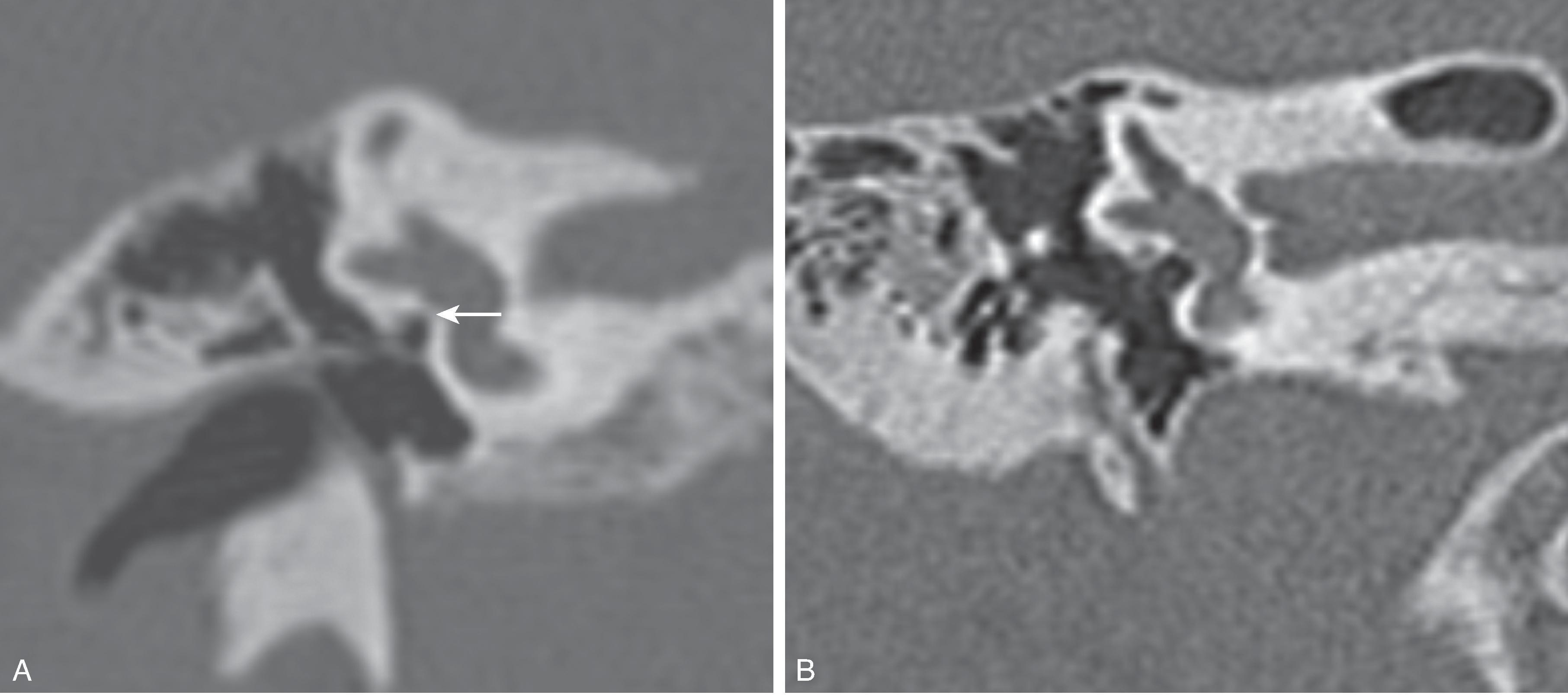 Fig. 13.11, Oval Window Atresia. (A) Coronal reformat CT demonstrating thickened oval window/absence of normal thinning of the bone at the oval window ( arrow ) as seen on a normal patient coronal CT image. In addition, the tympanic segment of the facial nerve is not seen below the lateral semicircular canal as is seen on this (B) coronal reformat CT from a normal patient.