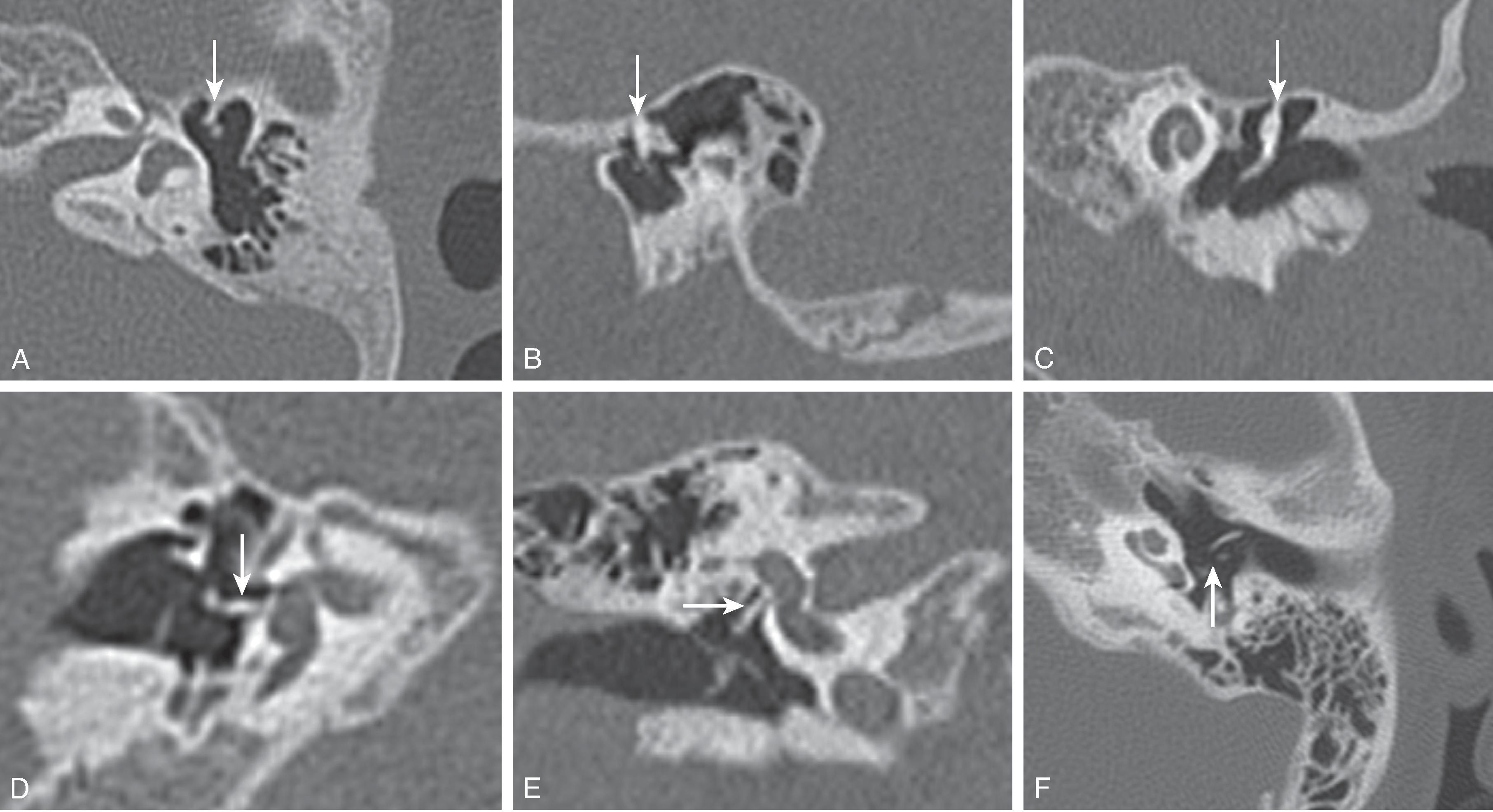 Fig. 13.12, Ossicular Anomalies. Malleus fixation: (A to C) Multiplanar CT images demonstrate an osseous bar fixating the head of the malleus ( arrows ). Monopod stapes: (D and E) Multiplanar CT images demonstrate a single thickened crus of the stapes ( arrows ). Incudo-stapedial dislocation: (F) Axial CT image demonstrates a gap between the incus and stapes ( arrow ).