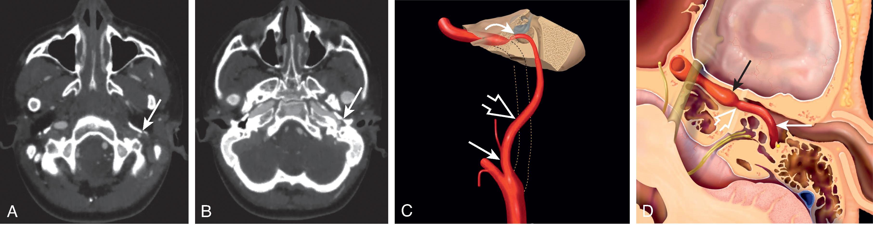 Fig. 13.13, Aberrant Internal Carotid Artery. (A and B) Axial CT angiogram images demonstrate a small inferior tympanic artery ( arrows ), which traverses through the middle ear cavity to join the horizontal petrous segment of the internal carotid artery (ICA). (C) Illustration depicts the failure of the cervical ICA to develop ( dotted lines ) with the ascending pharyngeal ( white solid arrow ), inferior tympanic ( white open arrow ), and caroticotympanic ( white curved arrow ) arteries providing an alternative collateral arterial channel, resulting in an aberrant ICA. (D) Axial illustration of the left temporal bone illustrates a classic aberrant internal carotid artery ( white solid arrow ) rising along the posterior cochlear promontory and crossing along the medial middle ear wall to rejoin the horizontal petrous ICA ( black solid arrow ). At the point of reconnection to the horizontal petrous ICA, stenosis ( white open arrow ) is often present. (C and D illustrations from StatDX, Copyright © 2022 Elsevier.)