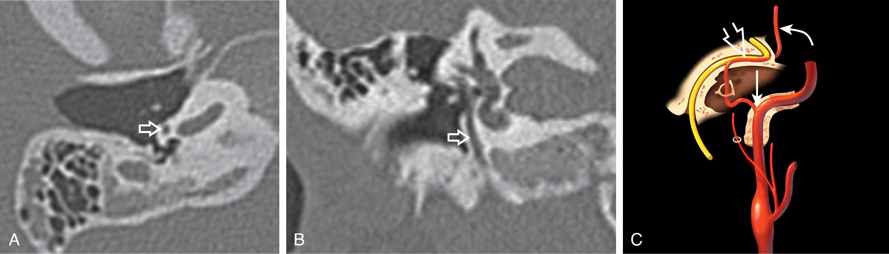 Fig. 13.14, Persistent Stapedial Artery. (A and B) Axial and coronal reformat CT images demonstrate linear density traversing the cochlear promontory consistent with a persistent stapedial artery ( arrows ). (C) Illustration shows the persistent stapedial artery (PSA) arising from the vertical segment of the petrous internal carotid artery ( white solid arrow ), passing through the stapes, and traveling along the tympanic segment of the facial nerve ( white open arrow ) to become the middle meningeal artery ( white curved arrow ). (C Illustration from StatDX, Copyright © 2022 Elsevier.)