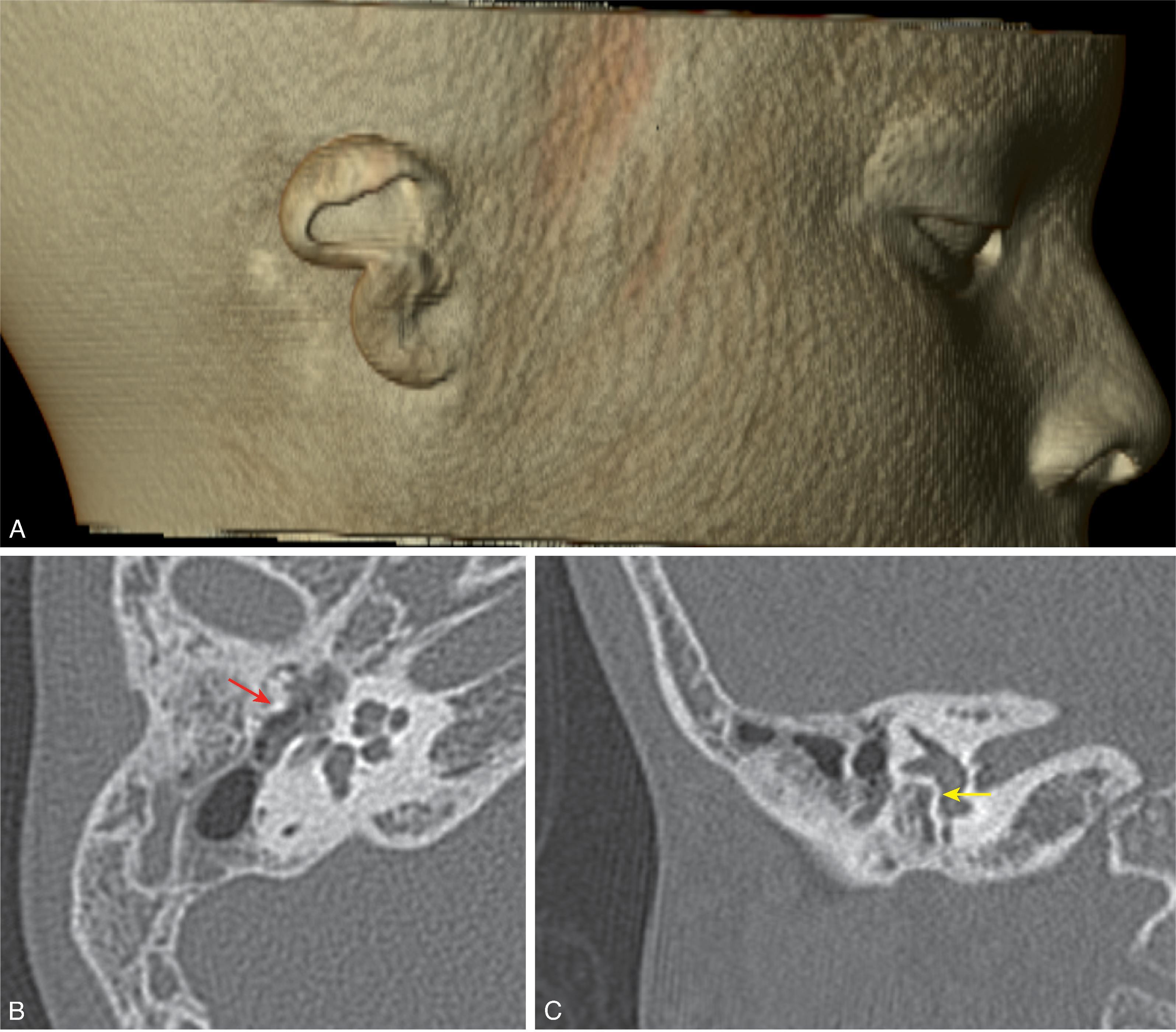 Fig. 13.15, External Auditory Canal Atresia. (A) A 3D volumetric CT image demonstrating malformation of the auricle. (B) Axial CT and (C) coronal reformat CT images demonstrate absent external auditory canal, atretic middle ear cavity, dysplastic incus ( red arrow ), absent stapes, and oval window atresia ( yellow arrow ).