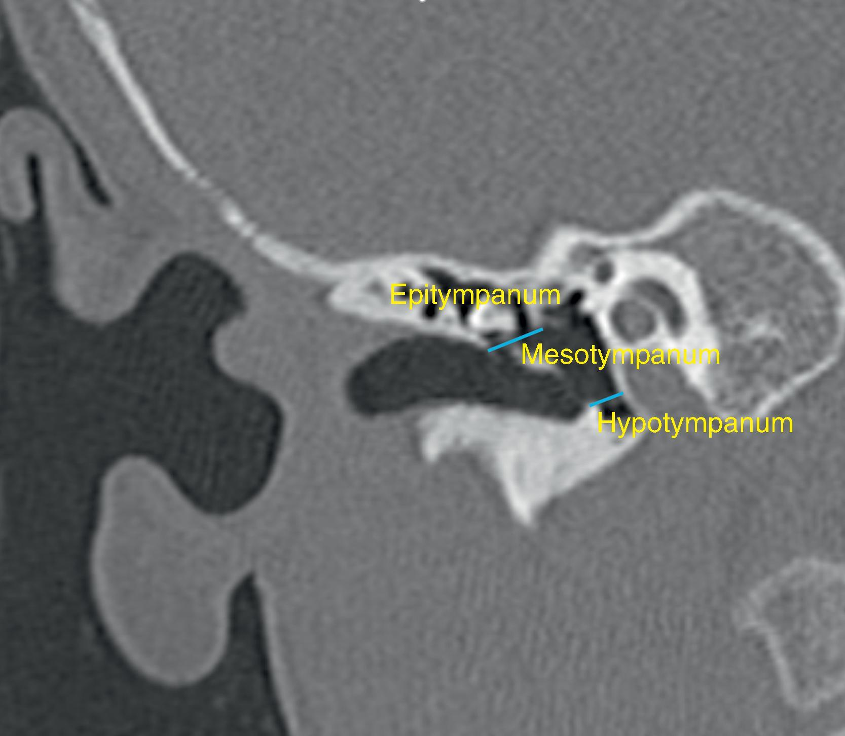 Fig. 13.2, Compartments of the middle ear.